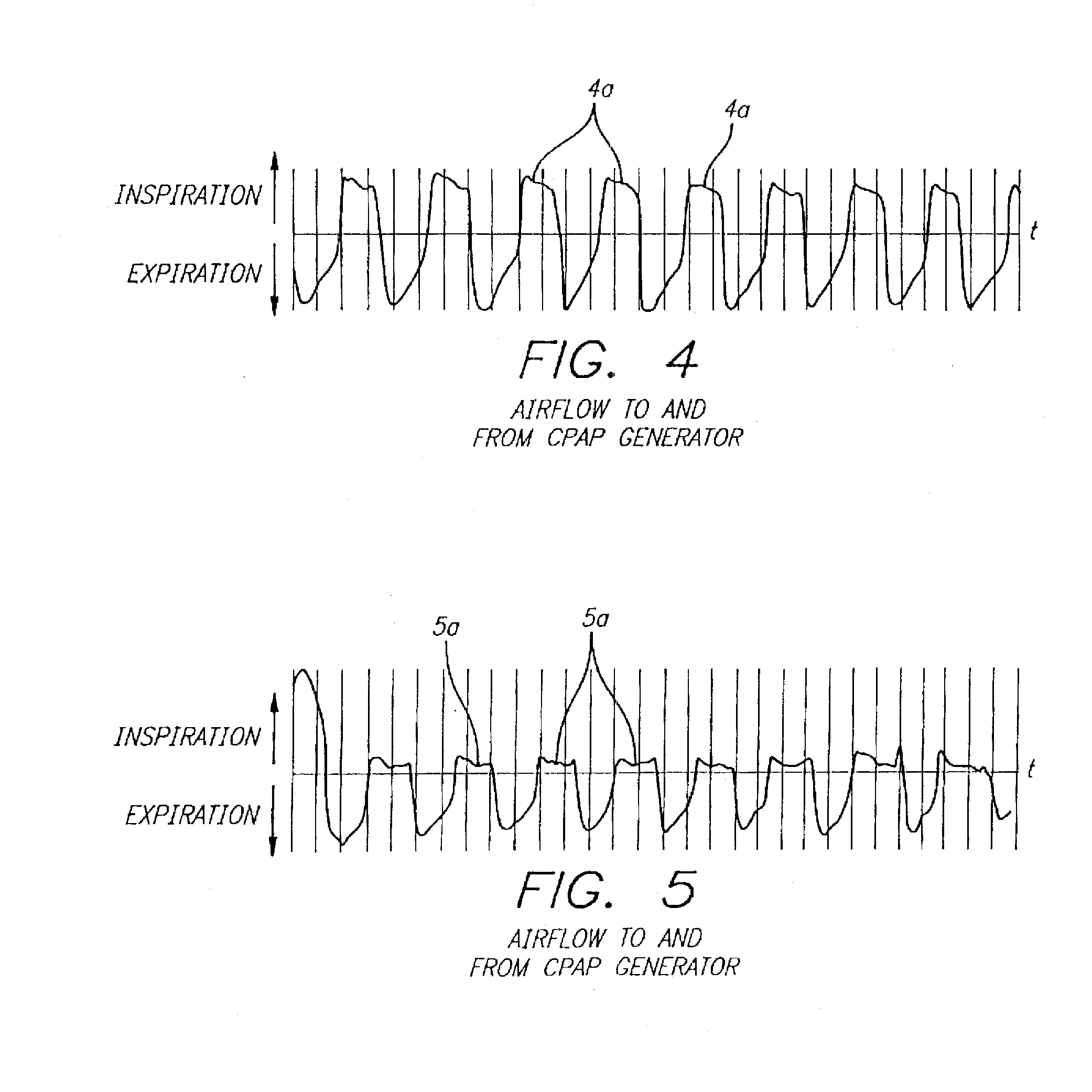 System and Method for Diagnosis and Treatment of Obstructive Sleep Apnea