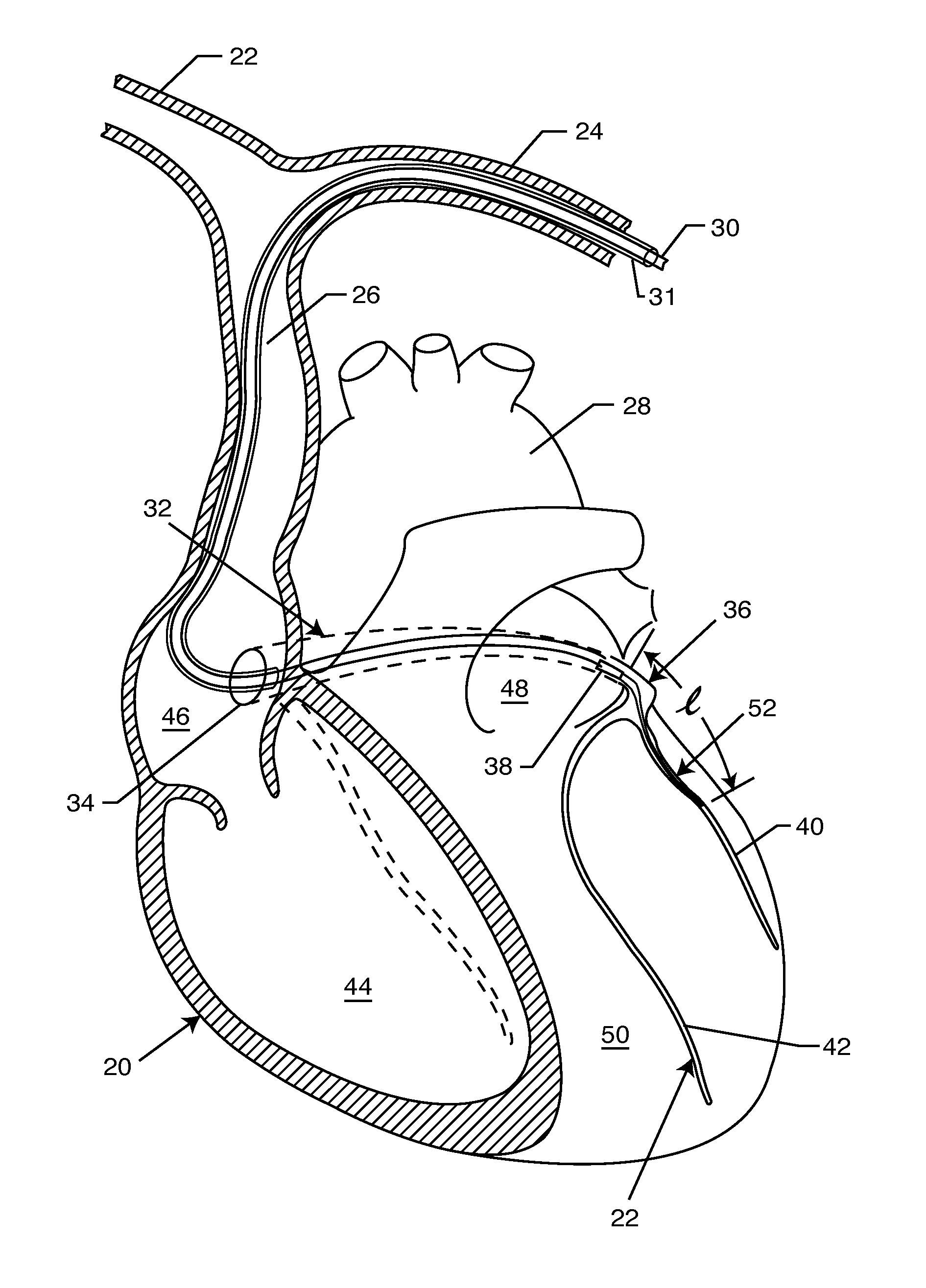 Medical lead system utilizing electromagnetic bandstop filters