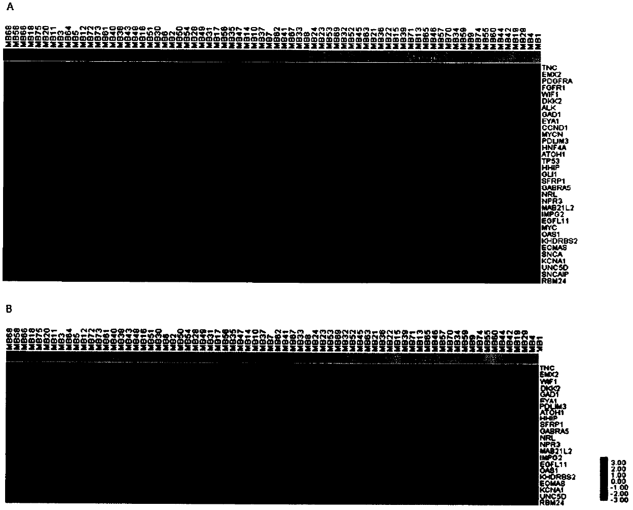 Genetic group for molecular subtyping of medulloblastoma and use of SNCA gene as biomarker of 4-type medulloblastoma