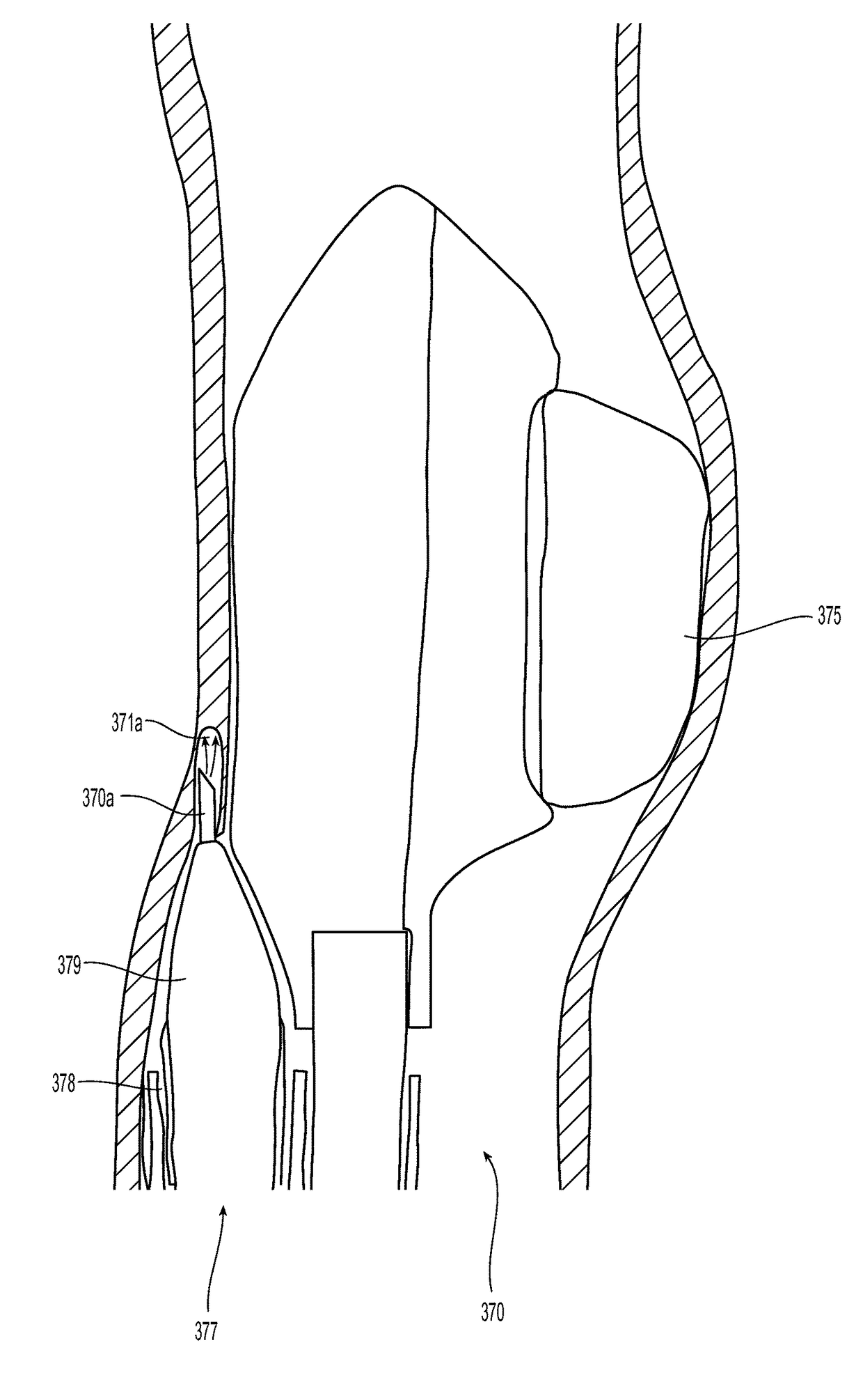 Systems and methods for endoluminal valve creation