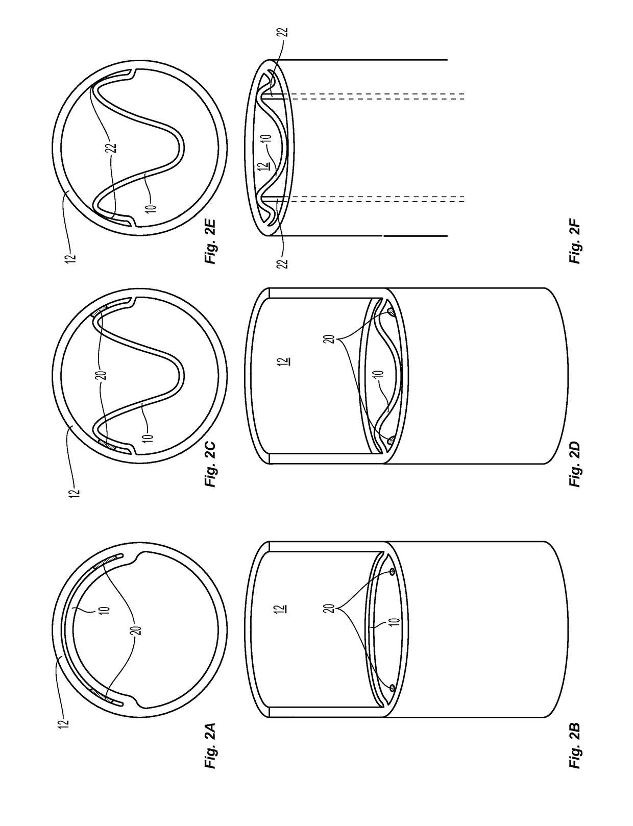 Systems and methods for endoluminal valve creation