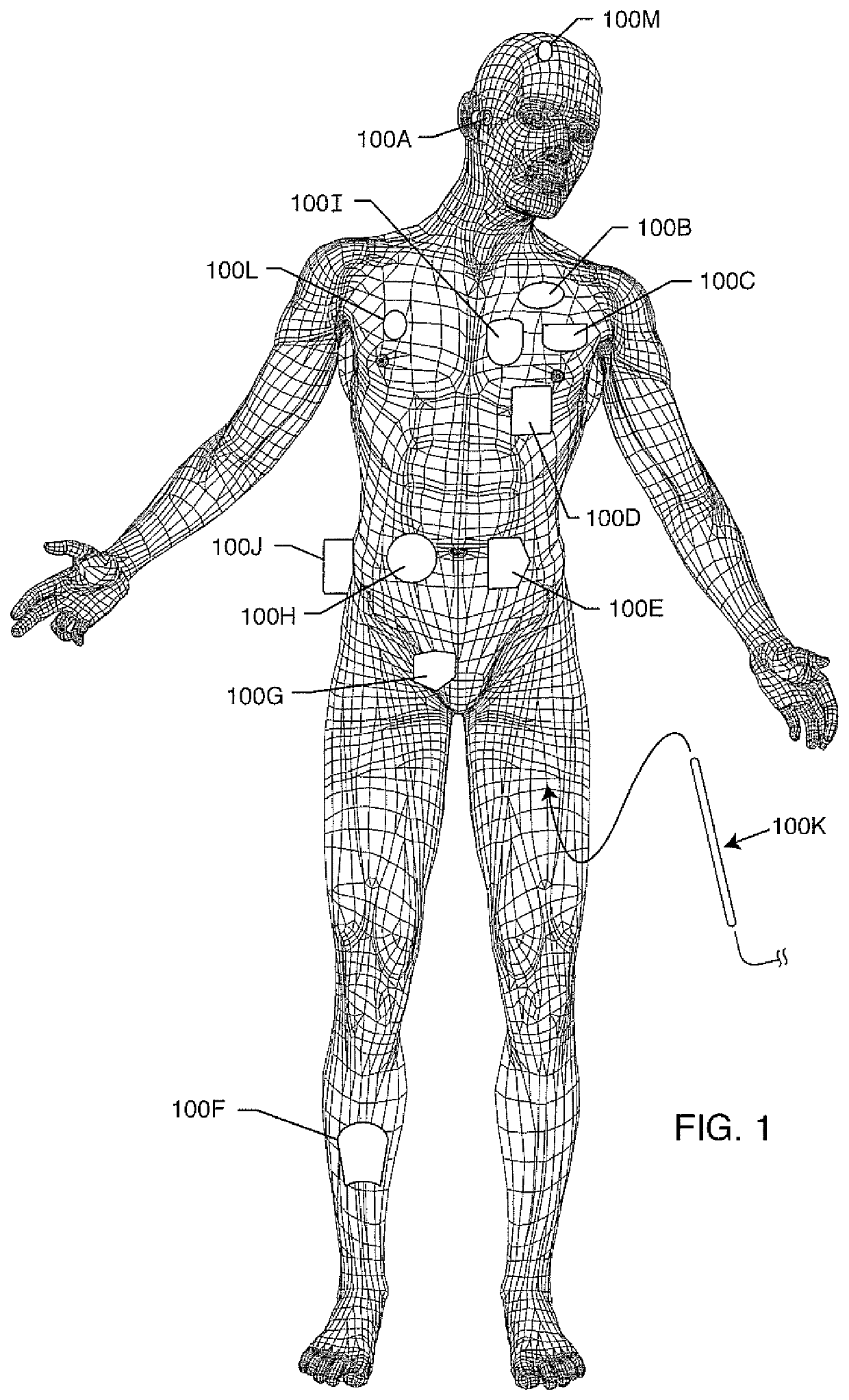 Filtered feedthrough assembly having a capacitor ground metallization electrically connected to the gold braze portion sealing a ferrule peninsula to a matching insulator cutout