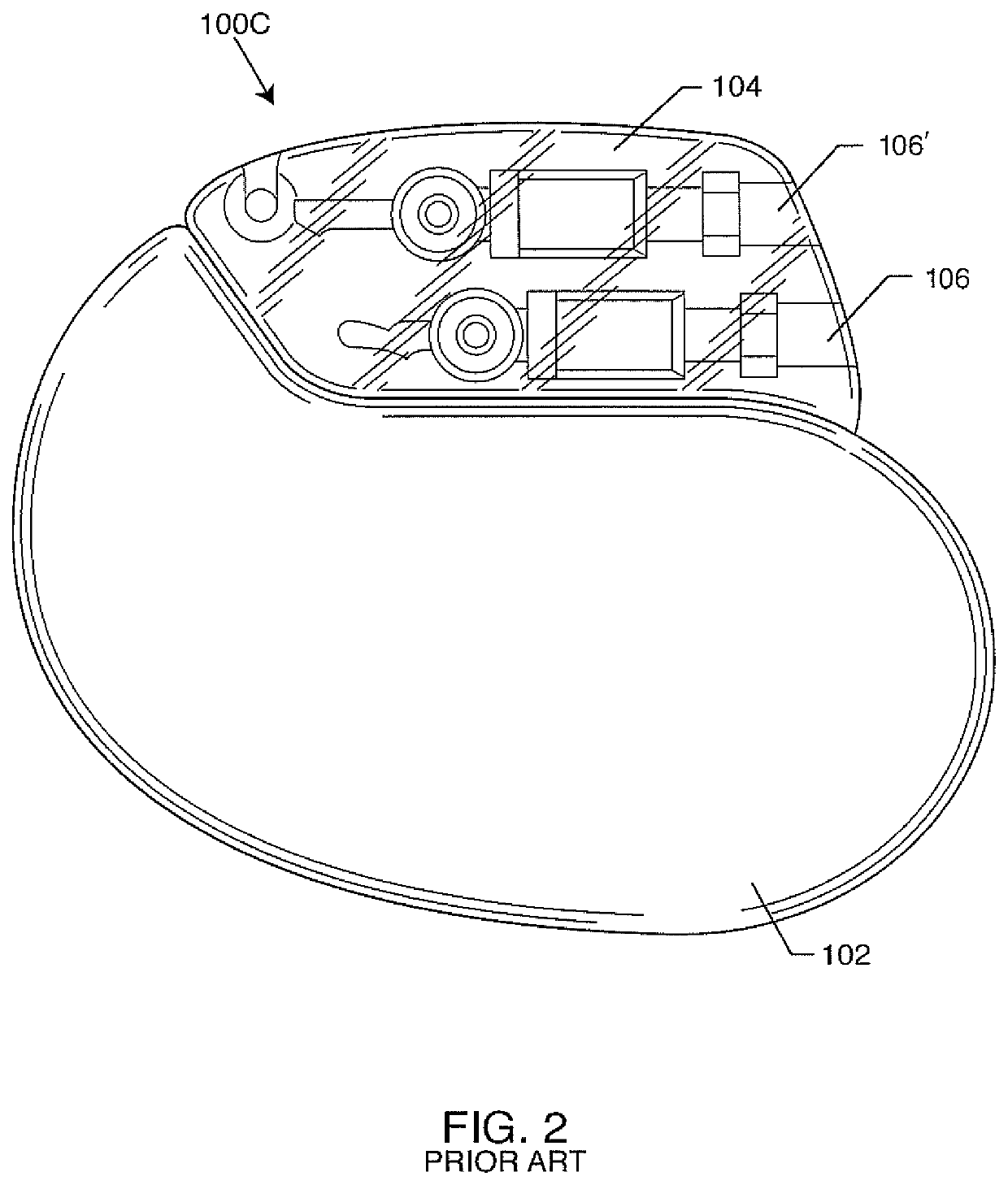 Filtered feedthrough assembly having a capacitor ground metallization electrically connected to the gold braze portion sealing a ferrule peninsula to a matching insulator cutout