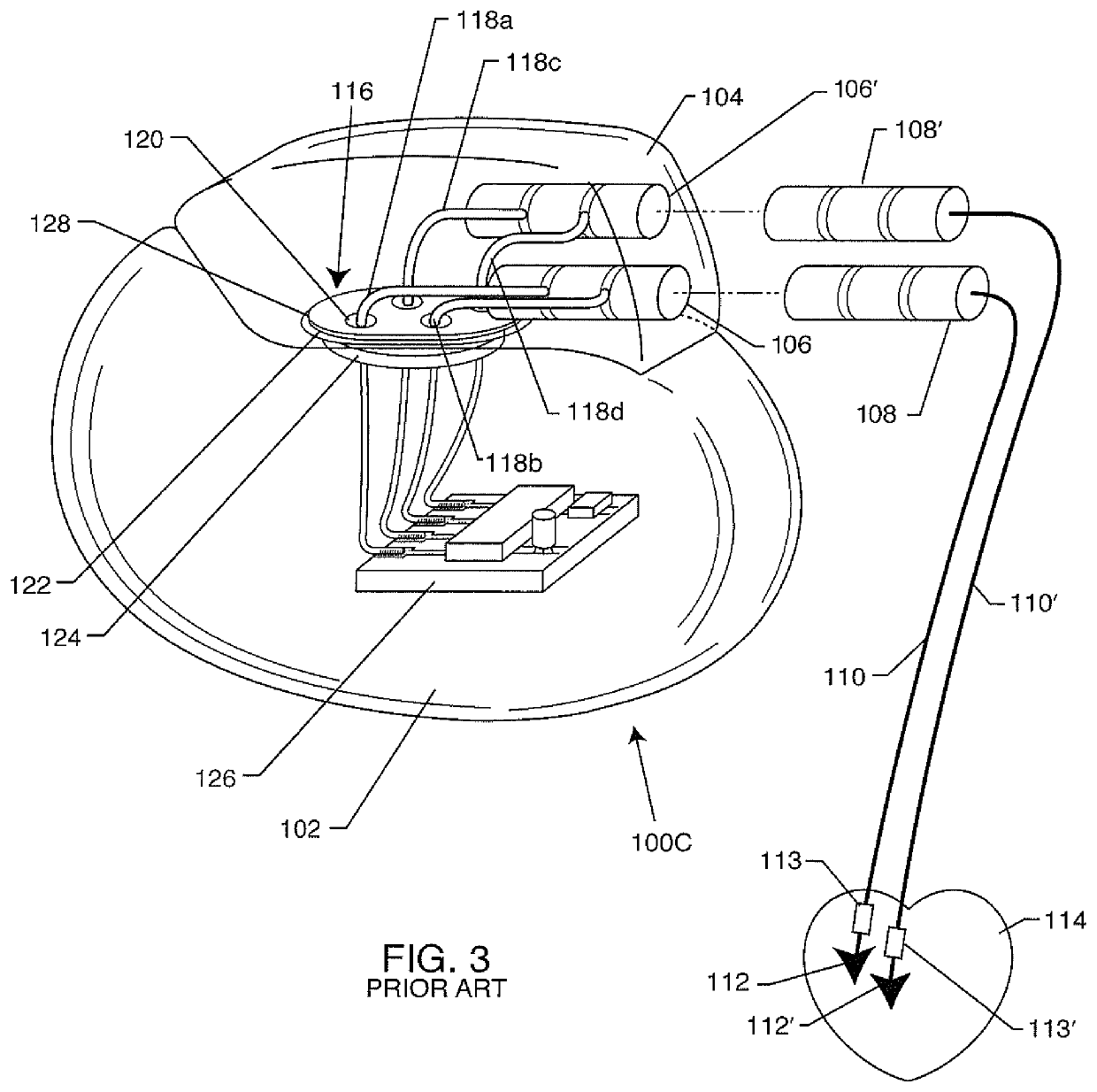 Filtered feedthrough assembly having a capacitor ground metallization electrically connected to the gold braze portion sealing a ferrule peninsula to a matching insulator cutout