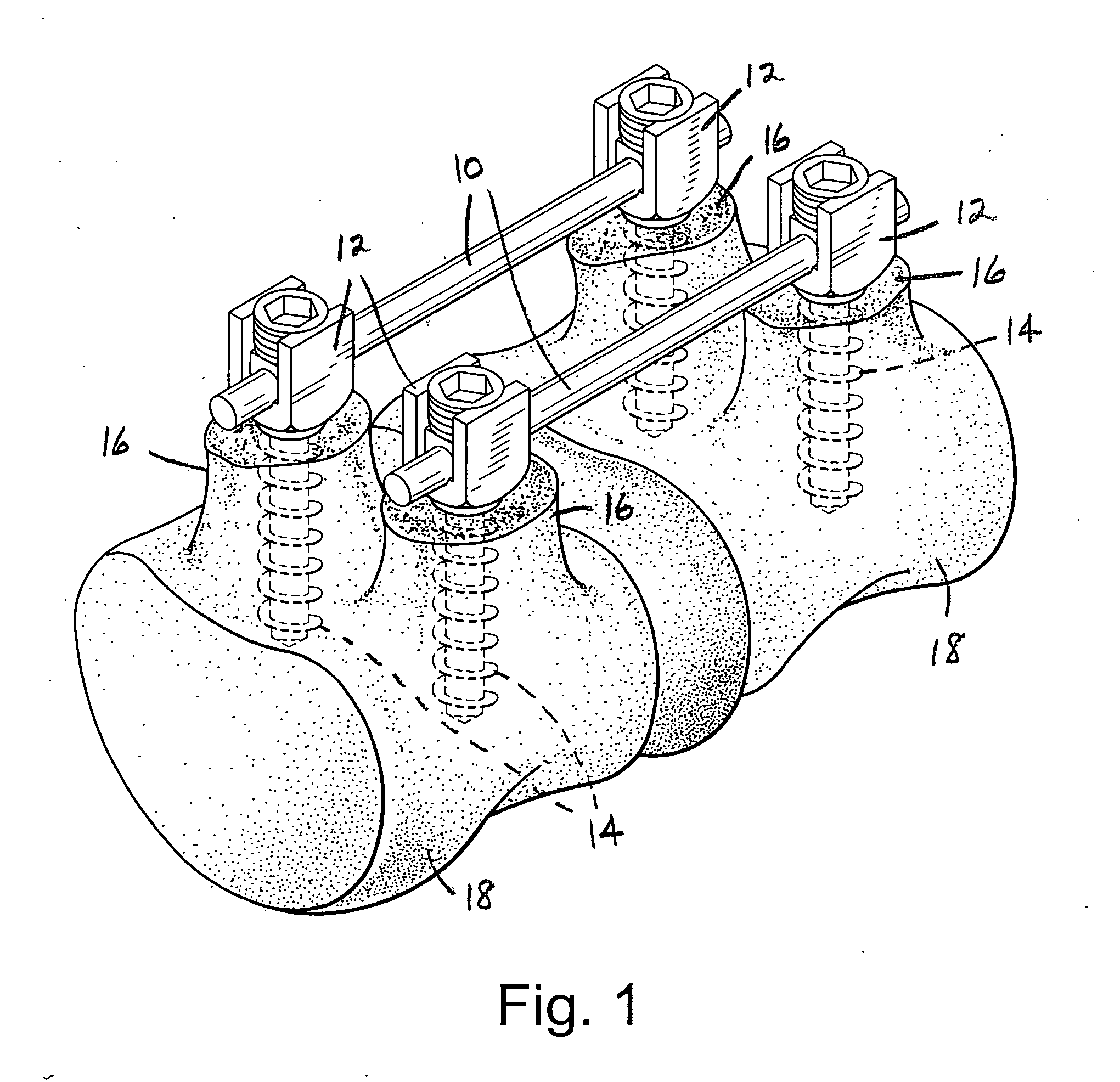 Apparatus and method for flexible spinal fixation