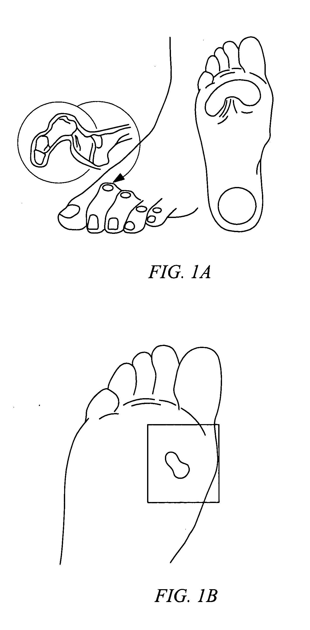 Electrosurgical method and system for treating foot ulcer