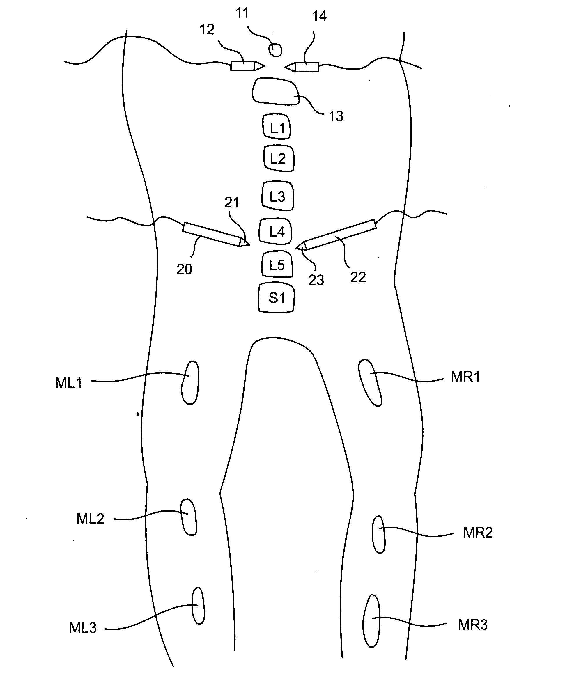 Electromyography system