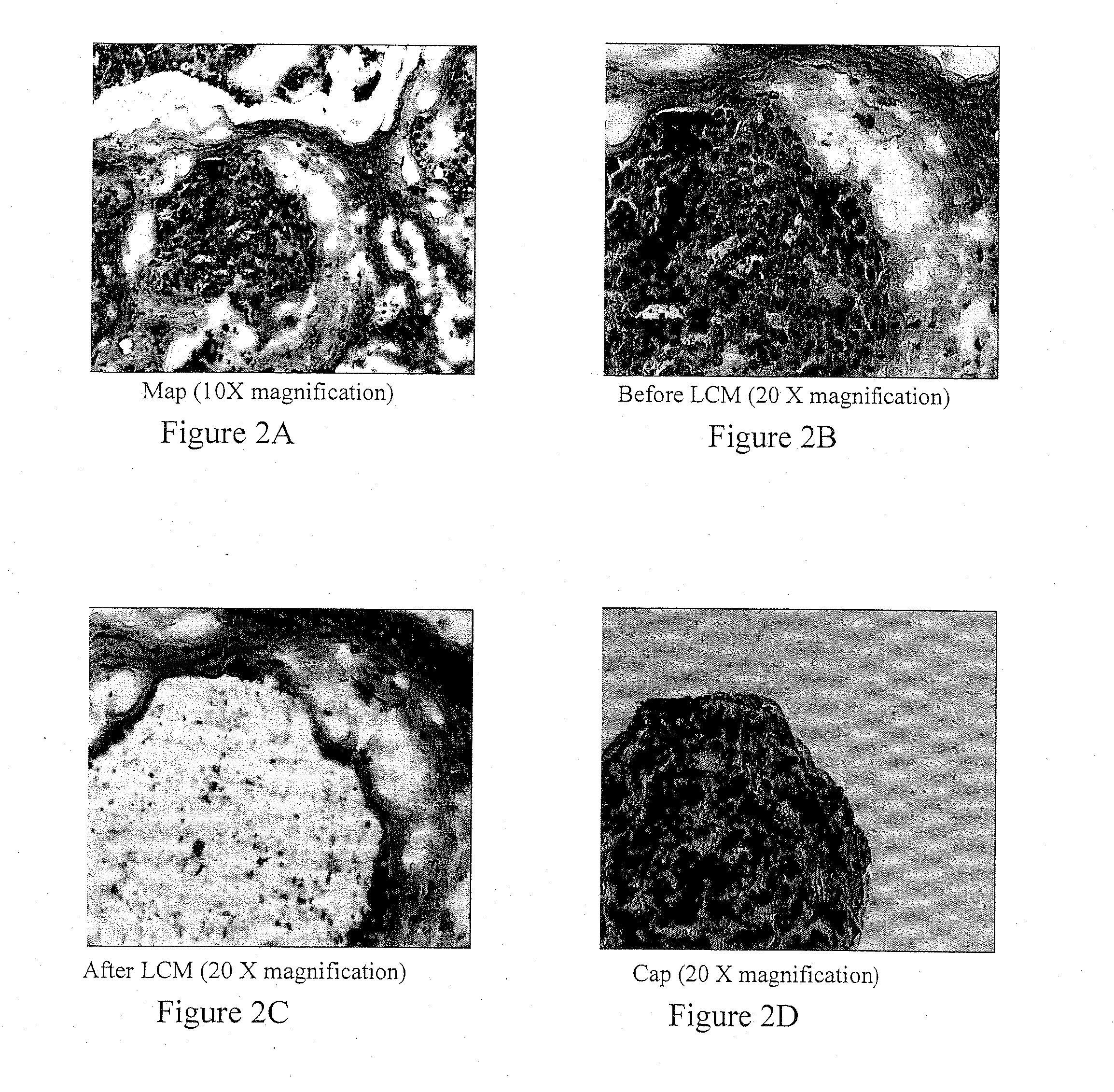 Methods for identifying an increased likelihood of recurrence of breast cancer