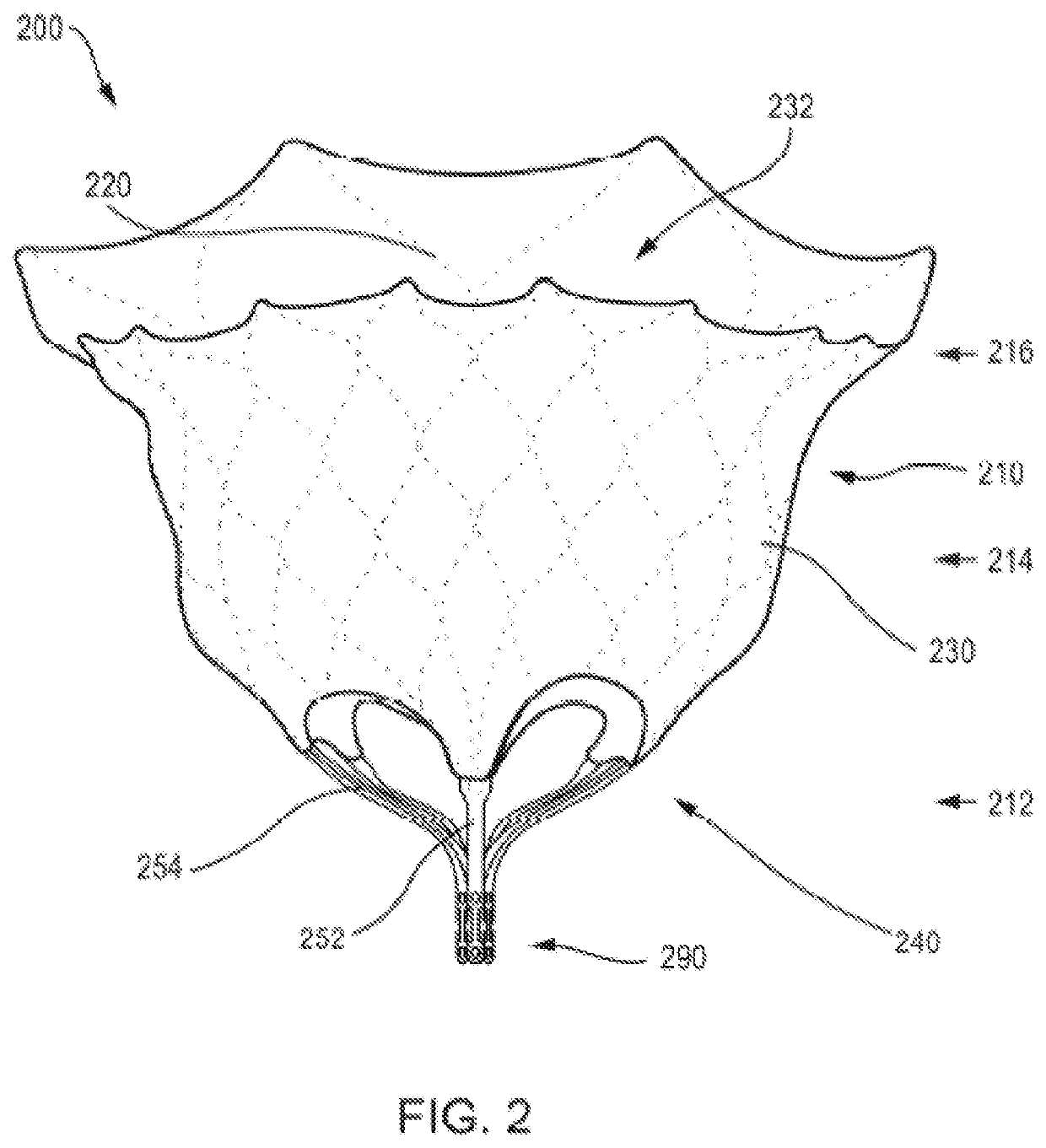 Prosthetic Heart Valve And Methods For Cardiac Hemodynamic Optimization And Monitoring