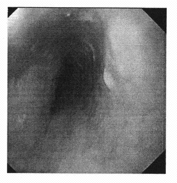 Chinese patent medicine for treating reflux esophagitis and preparation method thereof