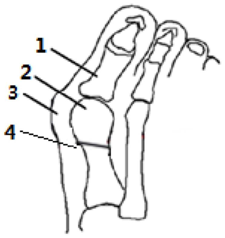 Metatarsal bone far-end osteotomy post-operation fixing device