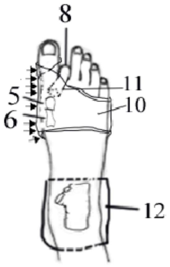 Metatarsal bone far-end osteotomy post-operation fixing device