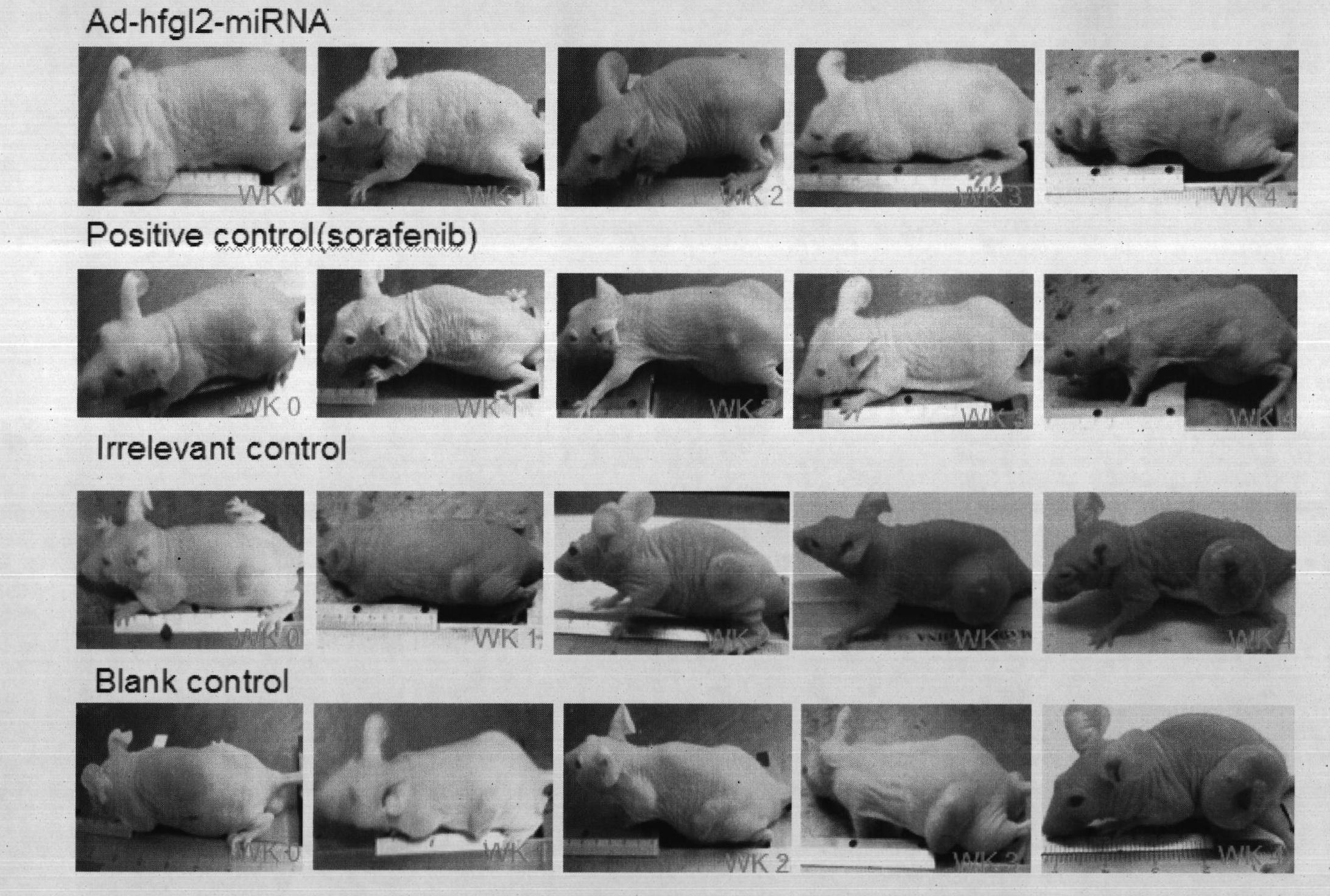 Application of hfgl2 (Human Fibrinogen-like protein 2) inhibitor in preparation of medicaments for treating liver cancer