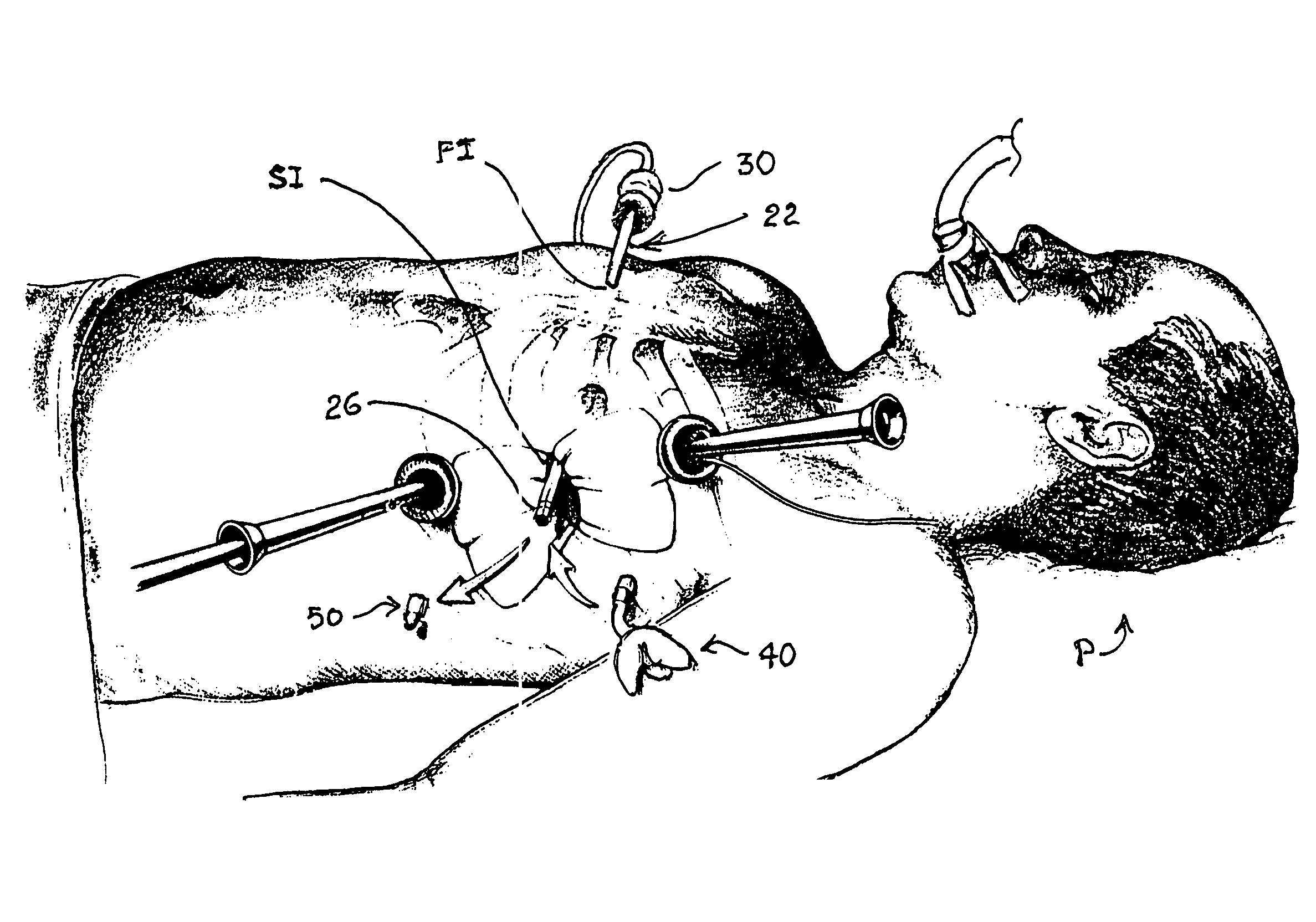 Methods and apparatus providing suction-assisted tissue engagement through a minimally invasive incision