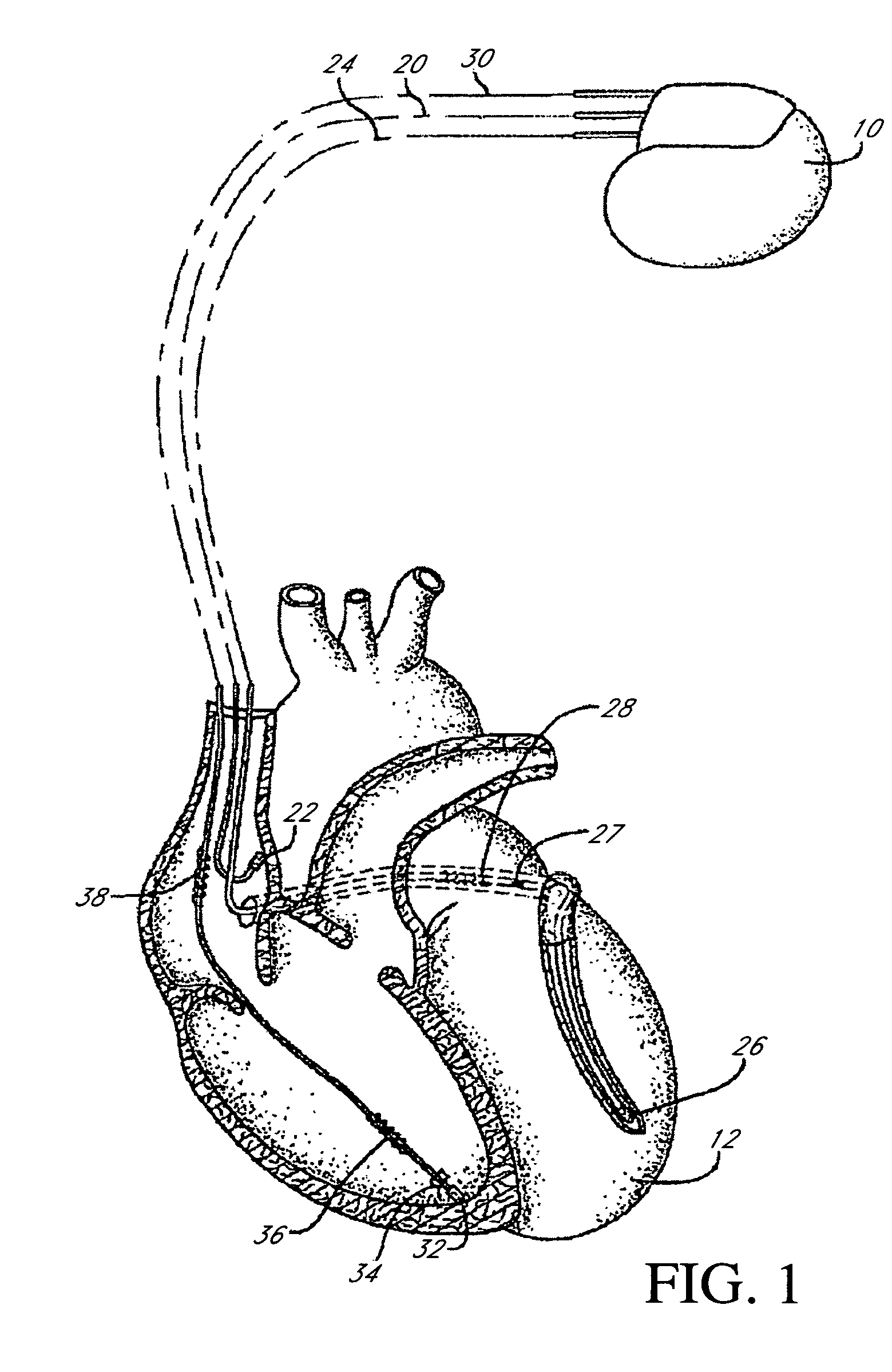 Automatic signal amplitude measurement system in the setting of abnormal rhythms