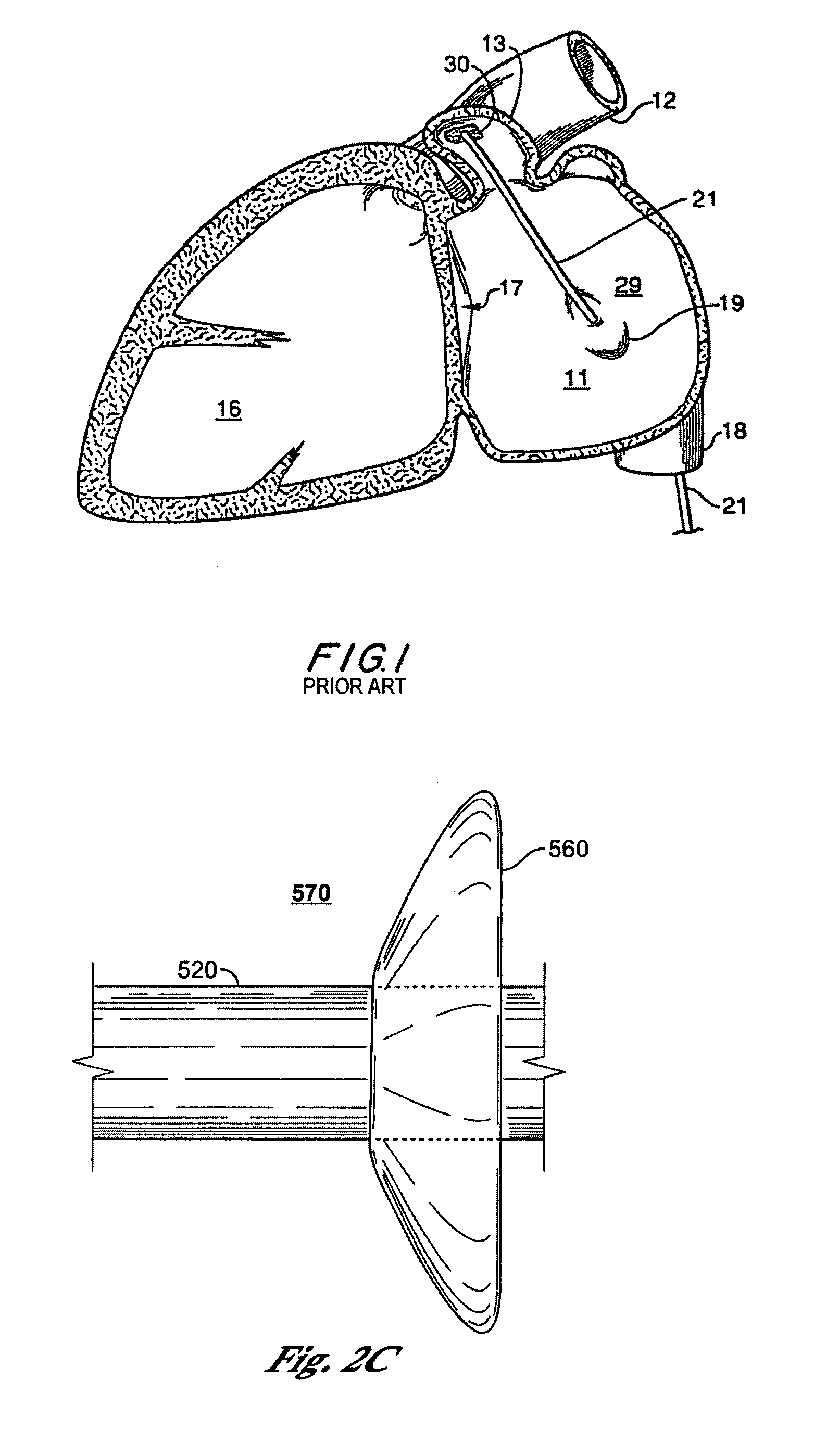 Apparatus for implanting devices in atrial appendages