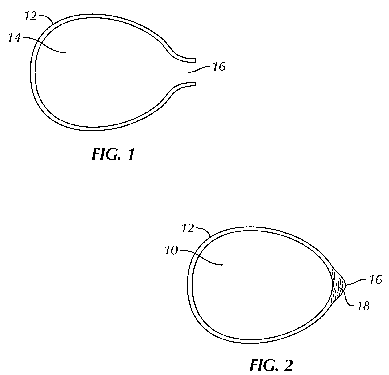 Breast implant implantation method and apparatus