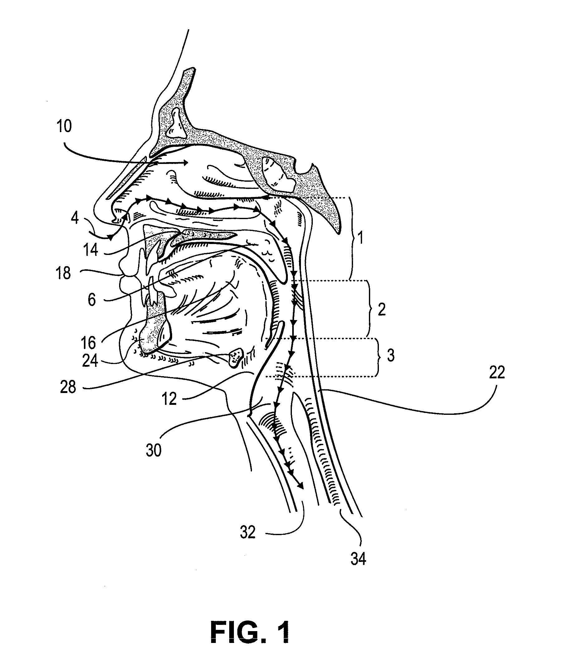 Partially erodable systems for treatment of obstructive sleep apnea