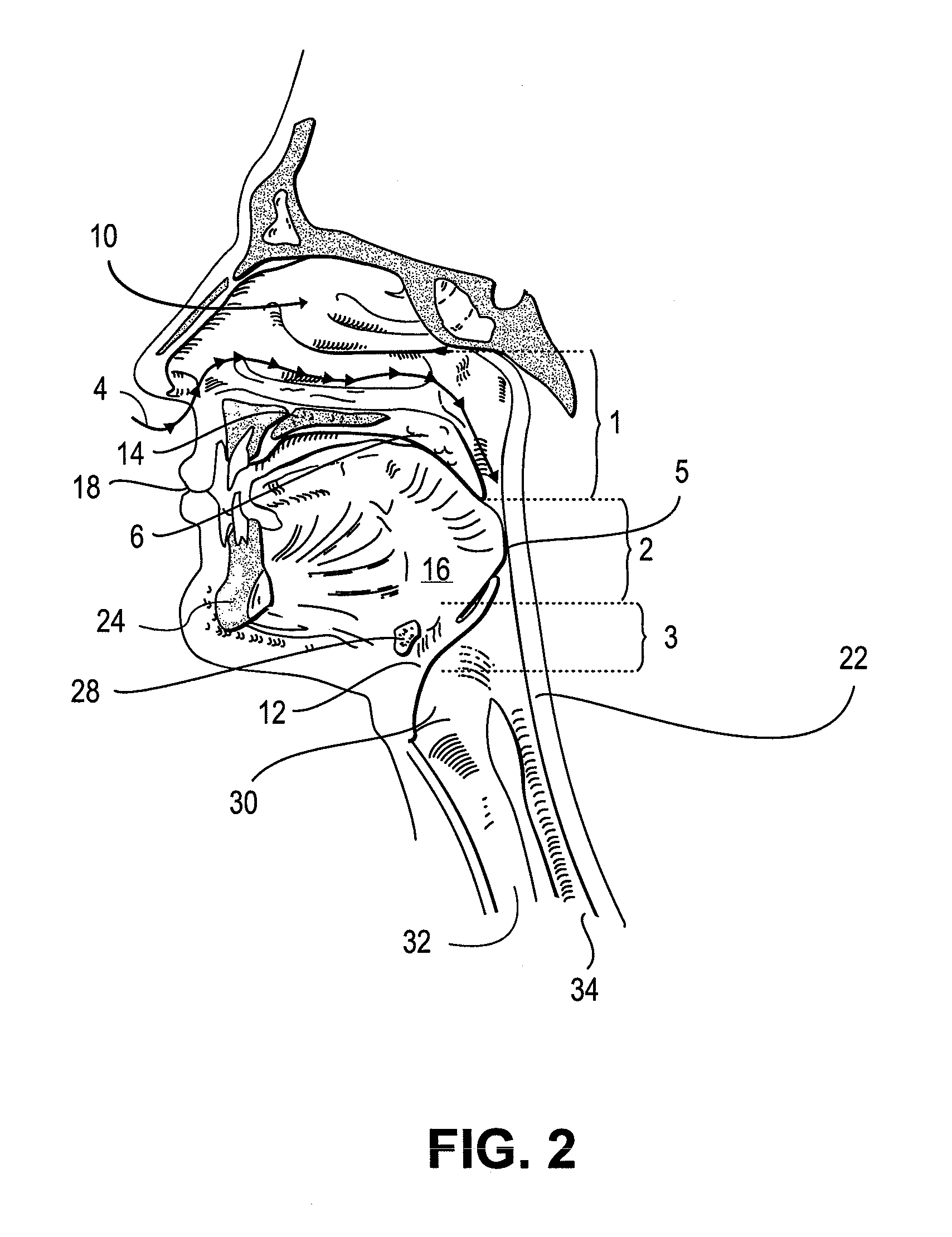 Partially erodable systems for treatment of obstructive sleep apnea