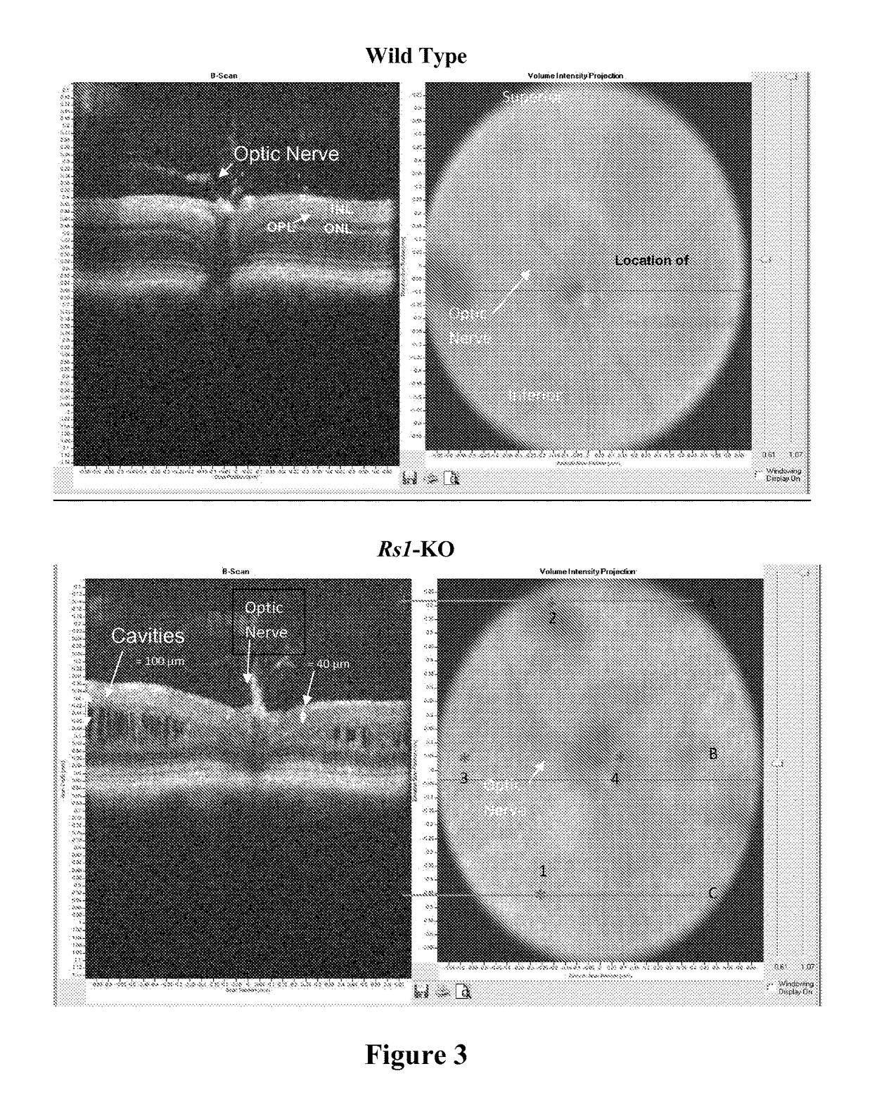 Methods and compositions for treating genetically linked diseases of the eye