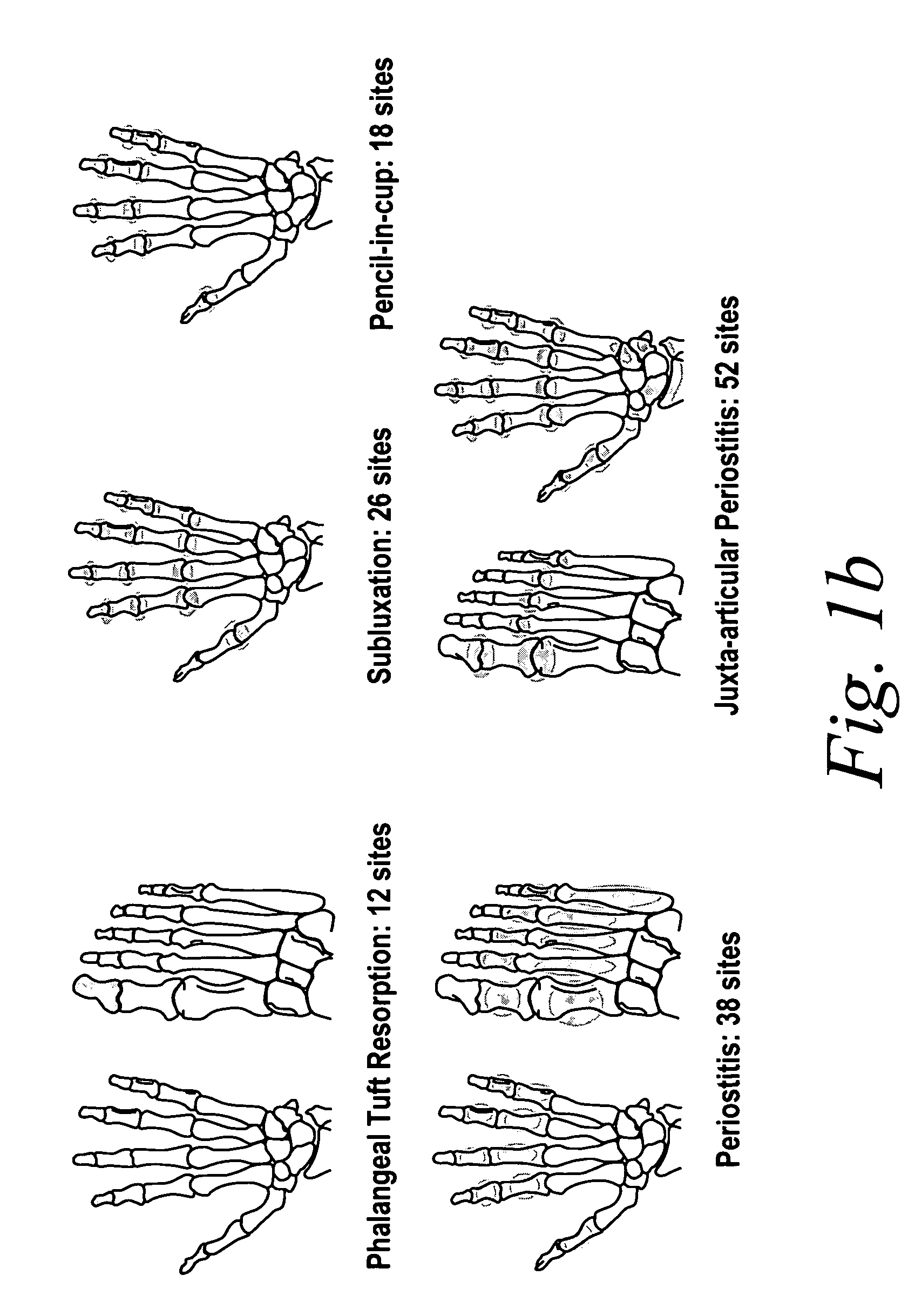 Use of human TNFα antibodies for treatment of erosive polyarthritis