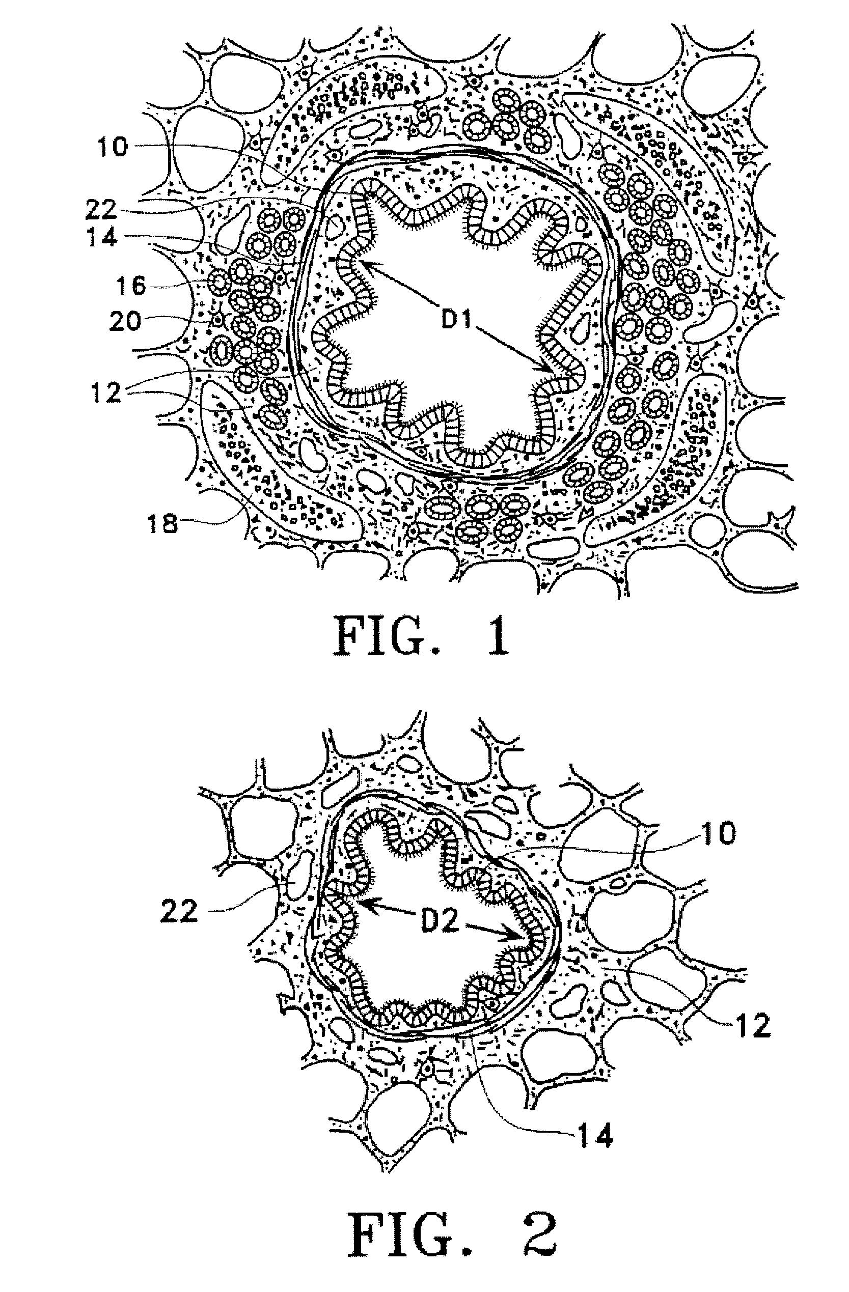 Methods of regenerating tissue in airways