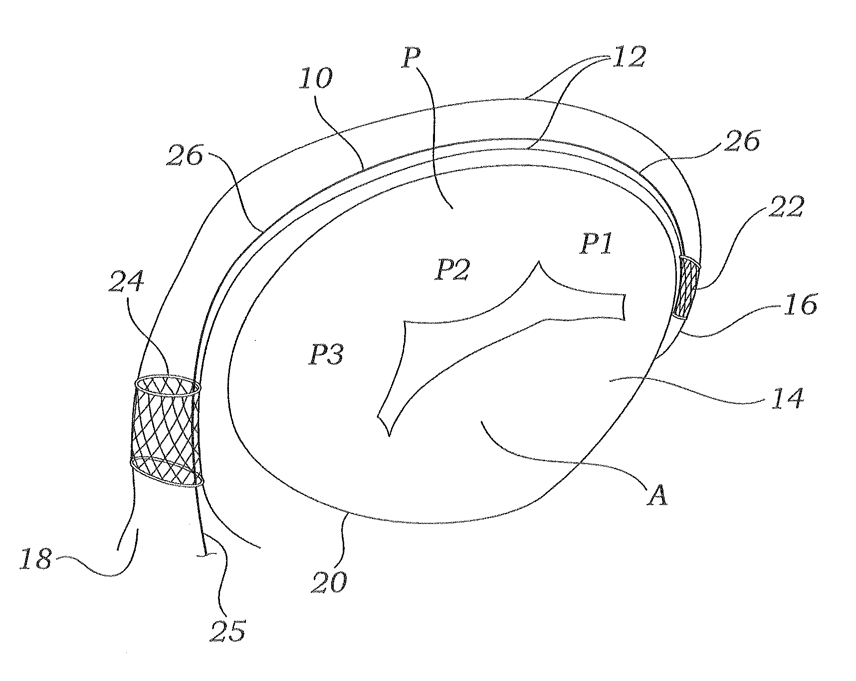 Retrievable implant and method for treatment of mitral regurgitation