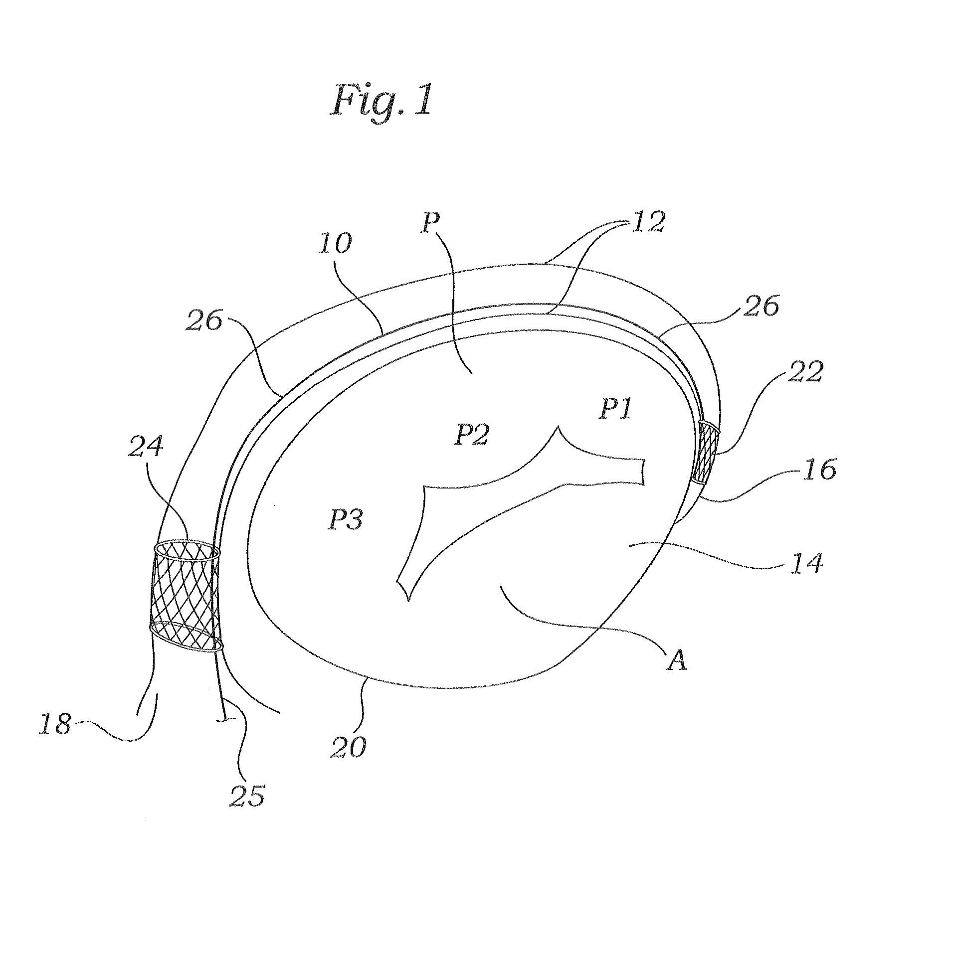 Retrievable implant and method for treatment of mitral regurgitation