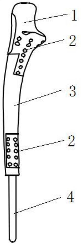 Customized ulna prosthesis