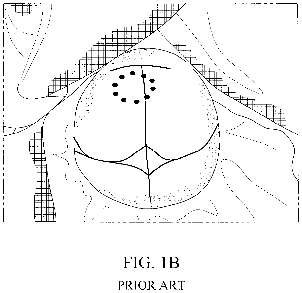 Method for performing single-stage cranioplasty reconstruction with a clear custom cranial implant