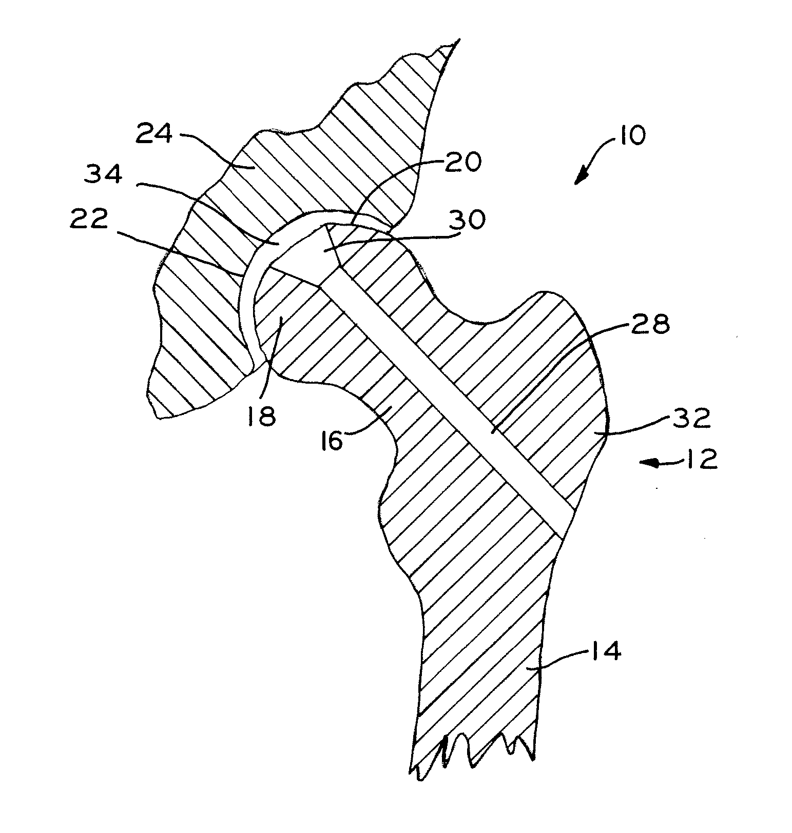 Methods for repairing defects in bone