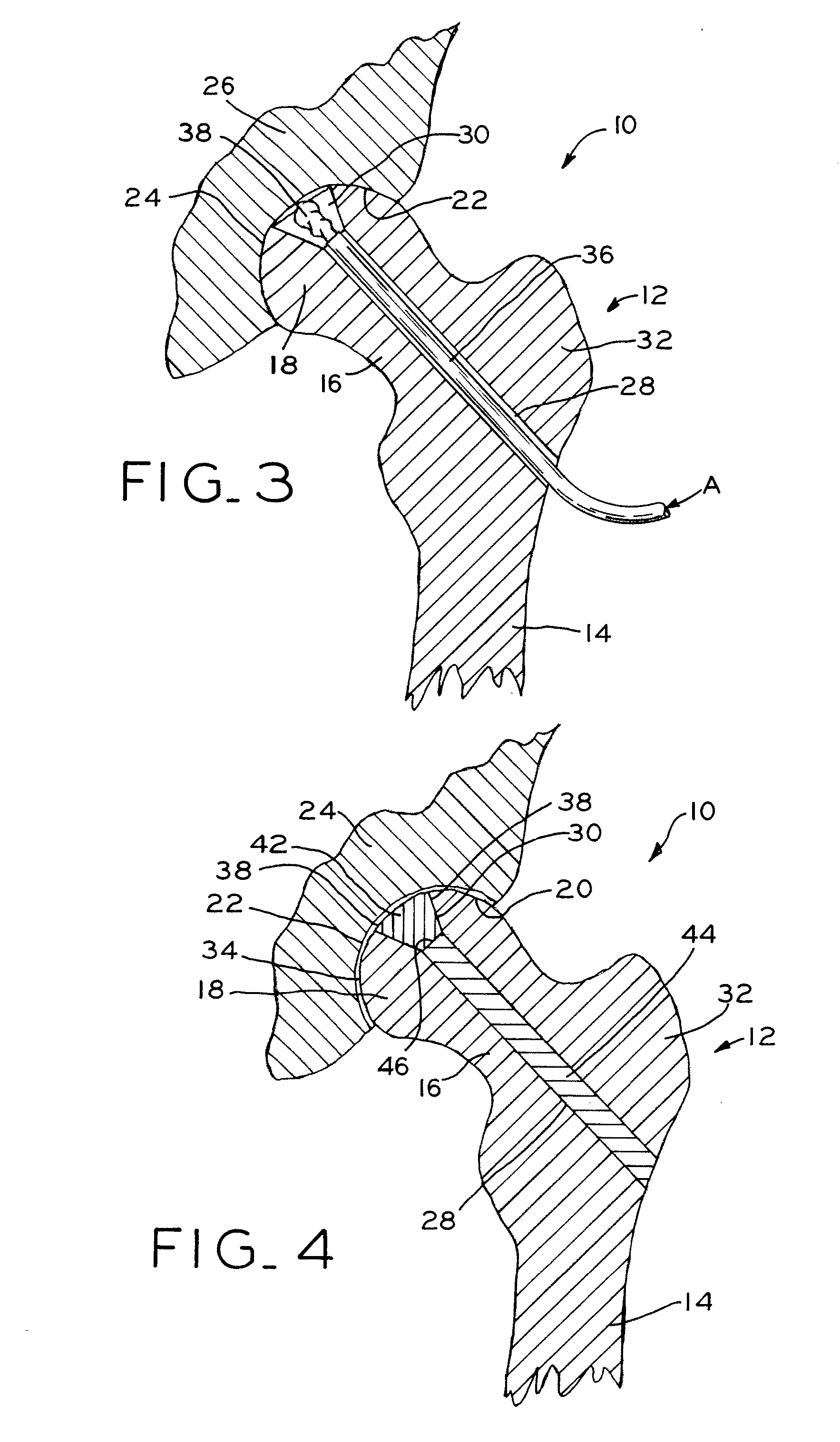 Methods for repairing defects in bone