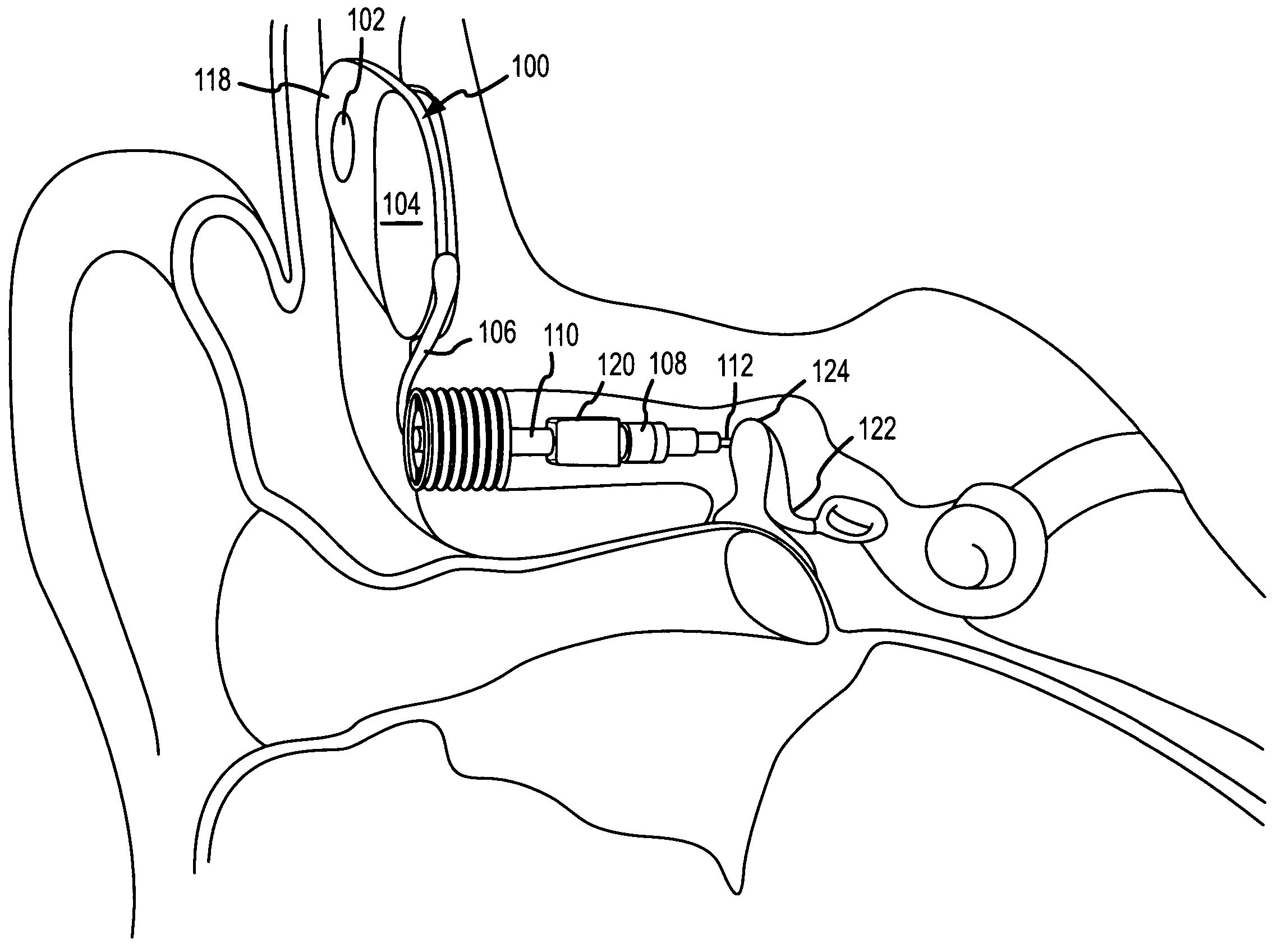 Implantable hearing aid transducer interface