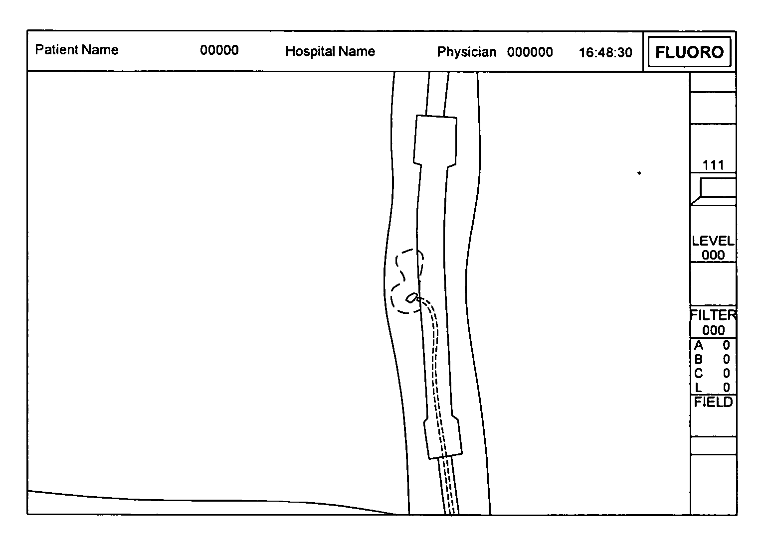 Method of Navigating Medical Devices in the Presence of Radiopaque Material