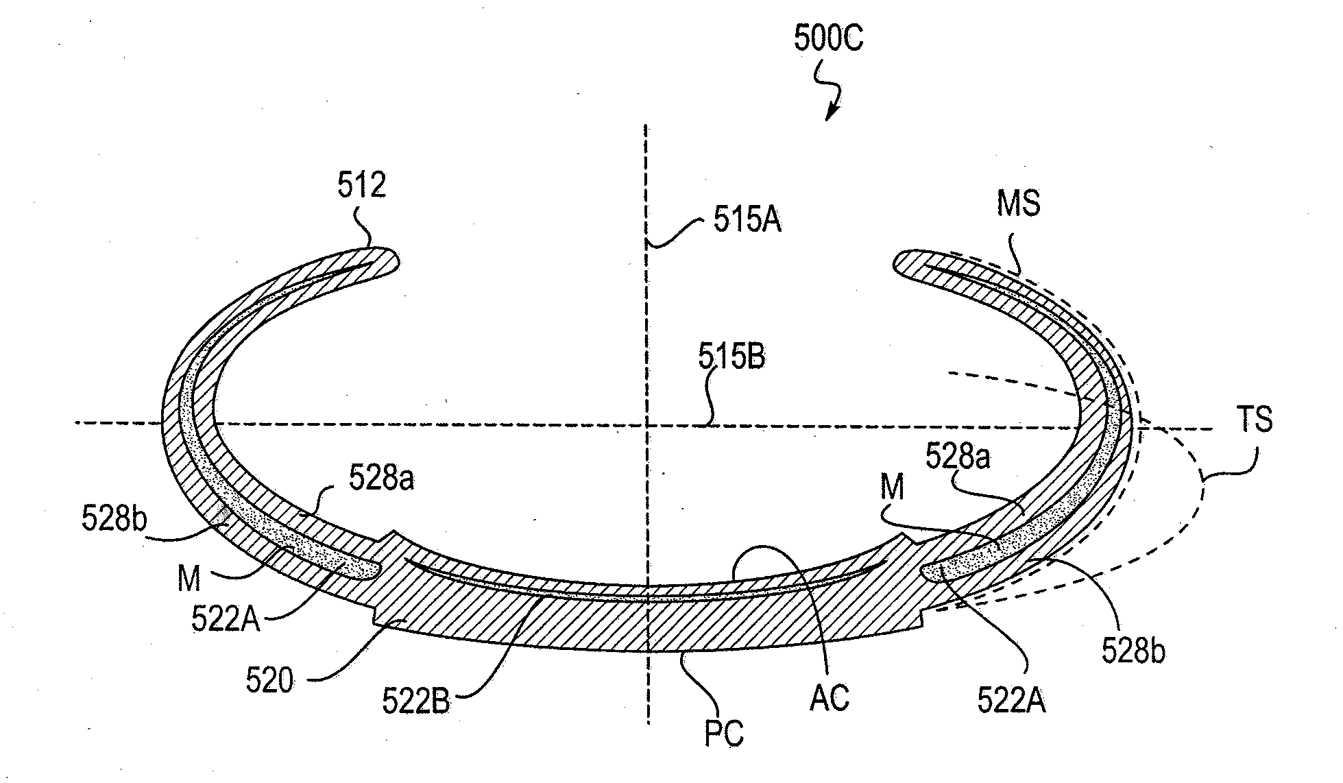 Post-Implant Accommodating Lens Modification