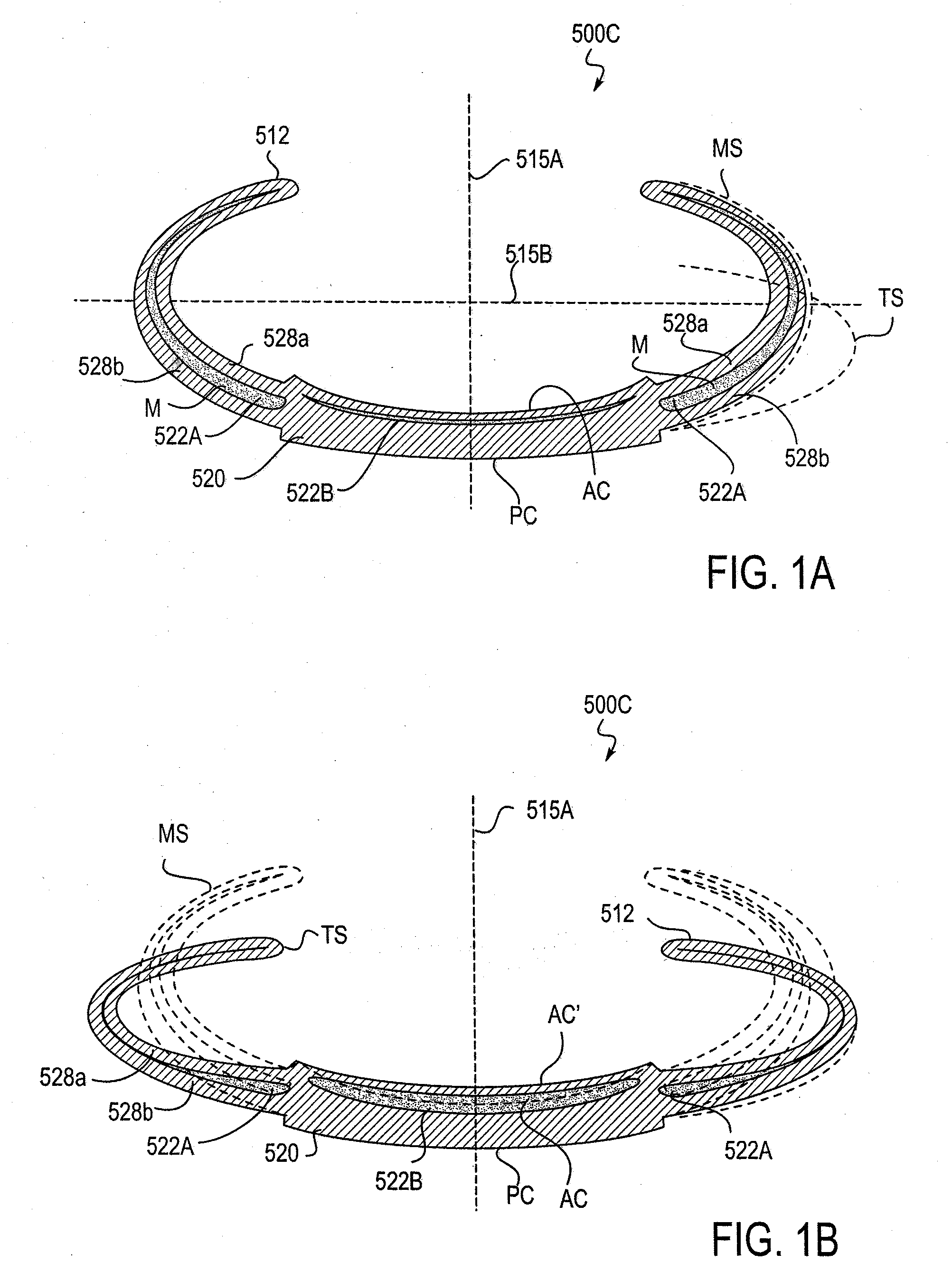 Post-Implant Accommodating Lens Modification