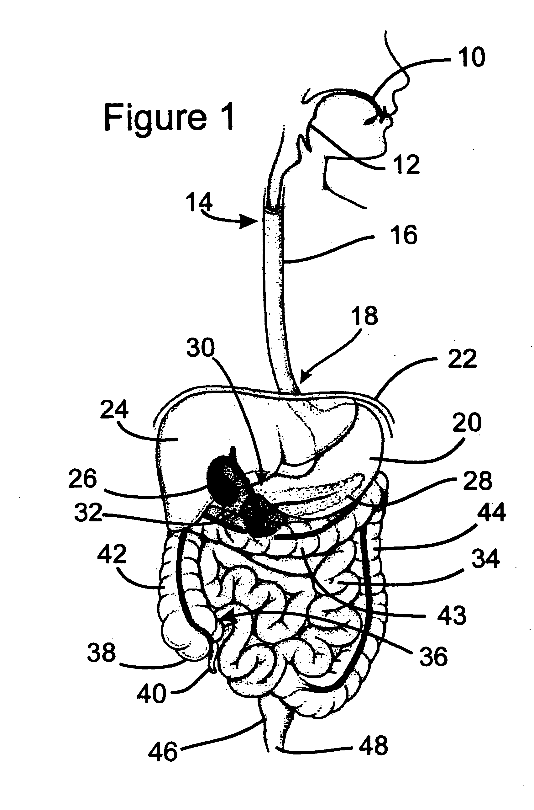 Tachygastrial electrical stimulation