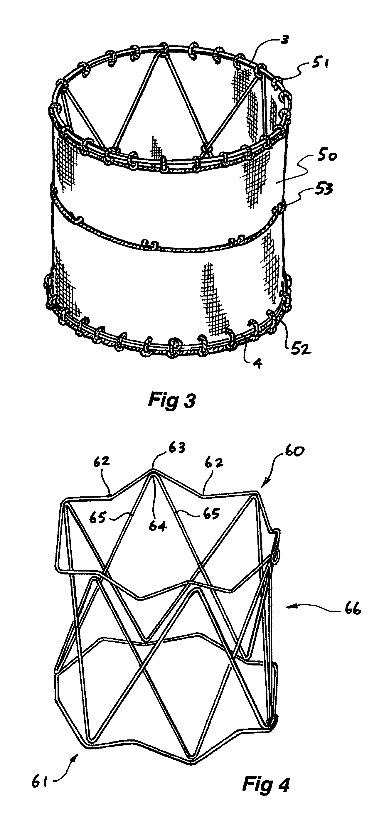 Ring stent