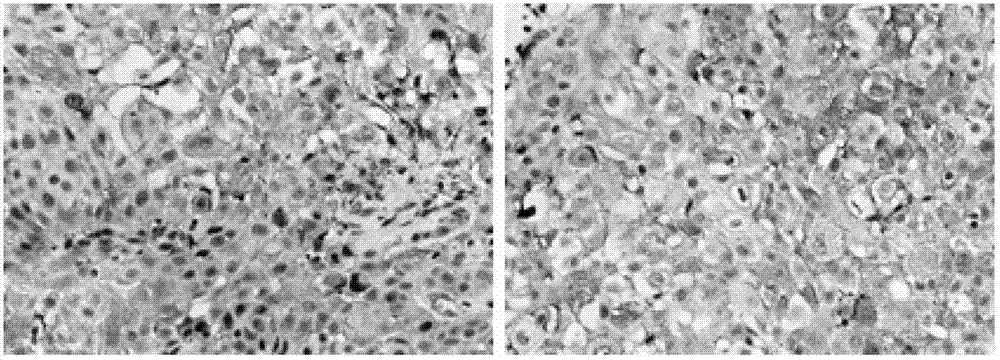 Application of esophageal squamous cell carcinoma primary tumor line CH-H-2