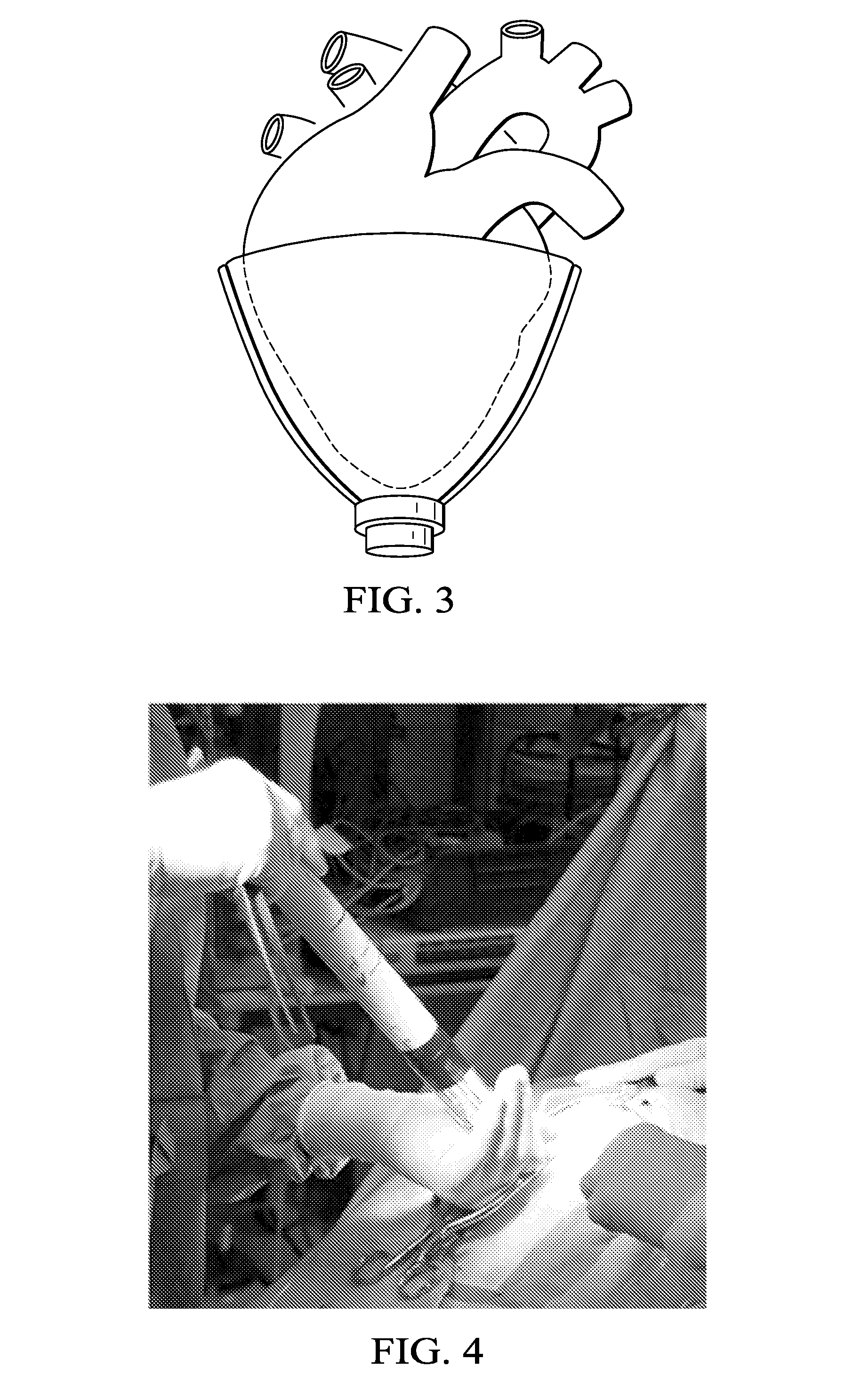 Deployment methods and mechanisms for minimally invasive implantation of heart contacting cardiac devices