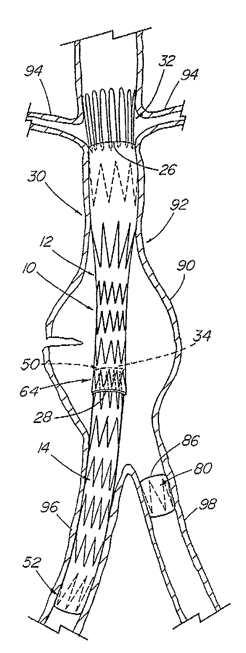 Modular stent graft assembly and use thereof