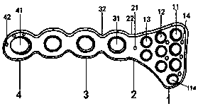 Internal anterior pelvic ring fixation plate