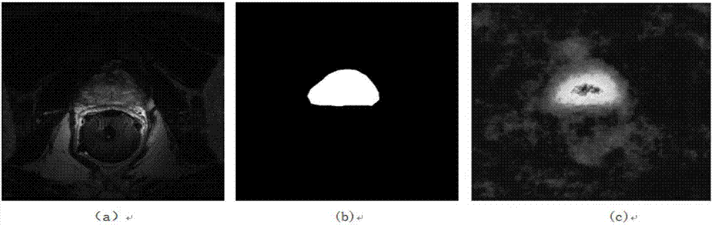 Computerized auxiliary diagnosing method for malignant tumor in early stage based on deep learning algorithm