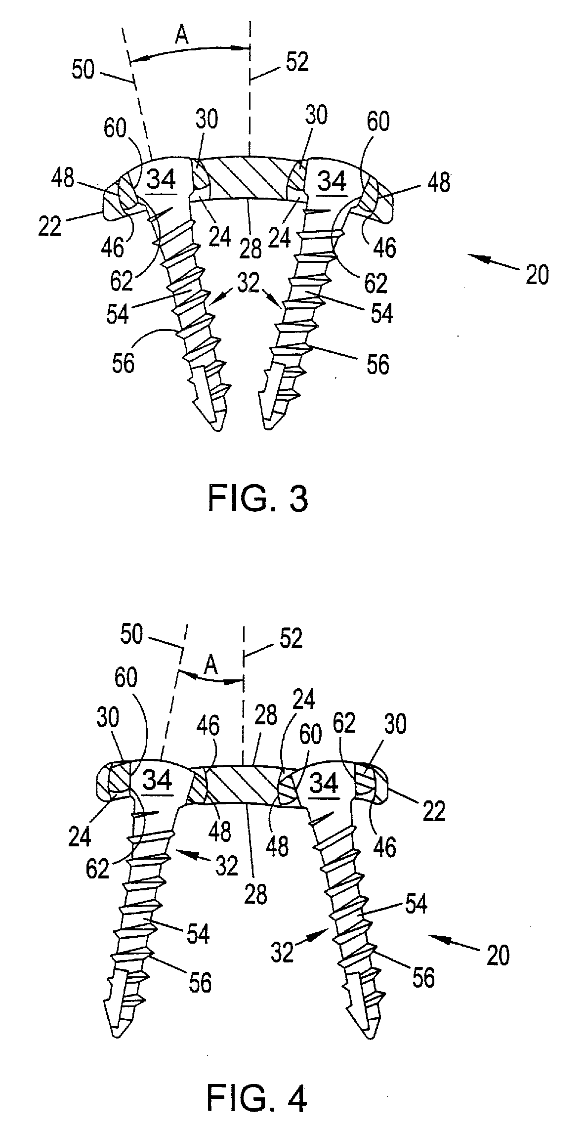 System and method for stabilizing the human spine with a bone plate