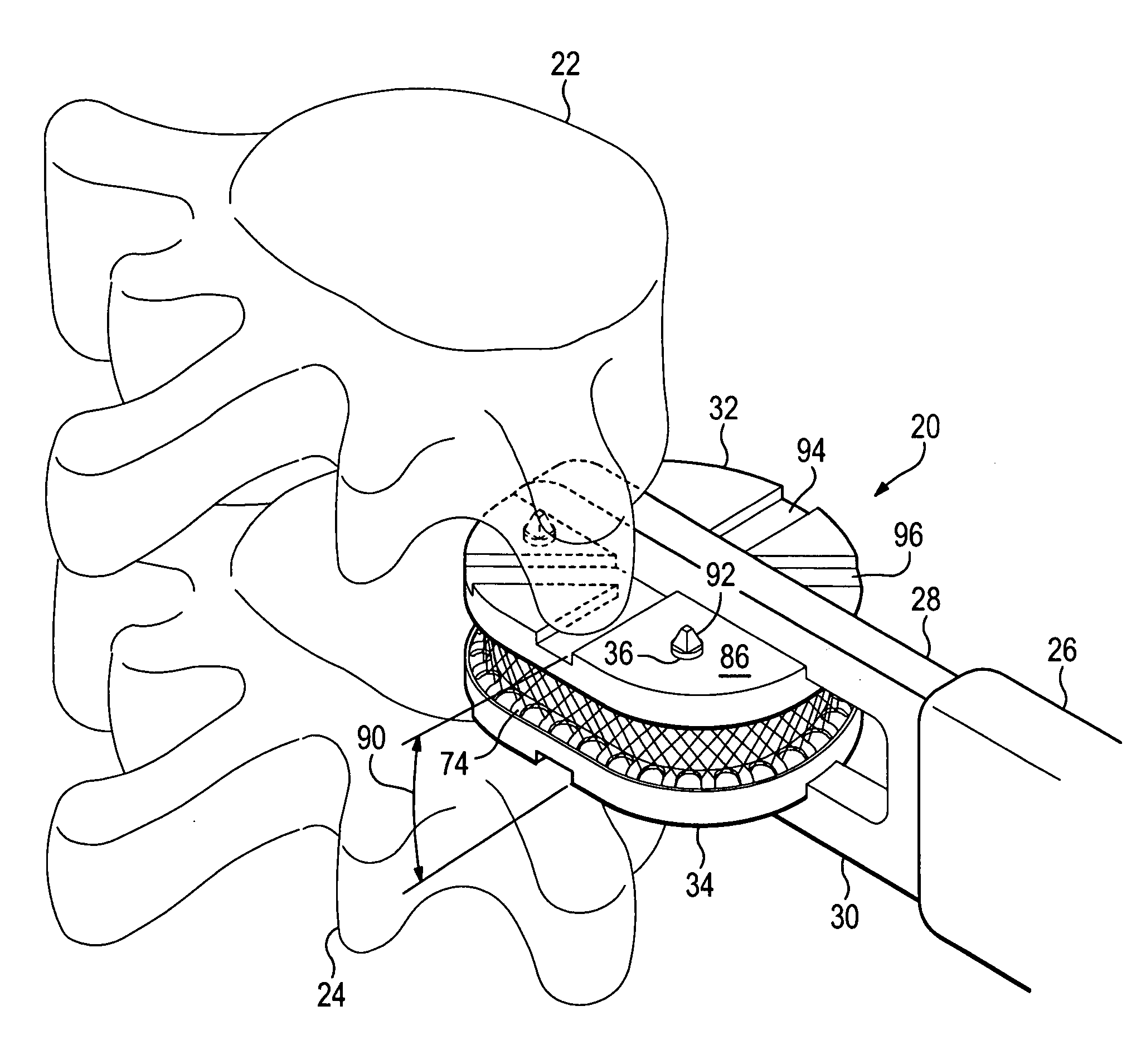 Anatomic total disc replacement