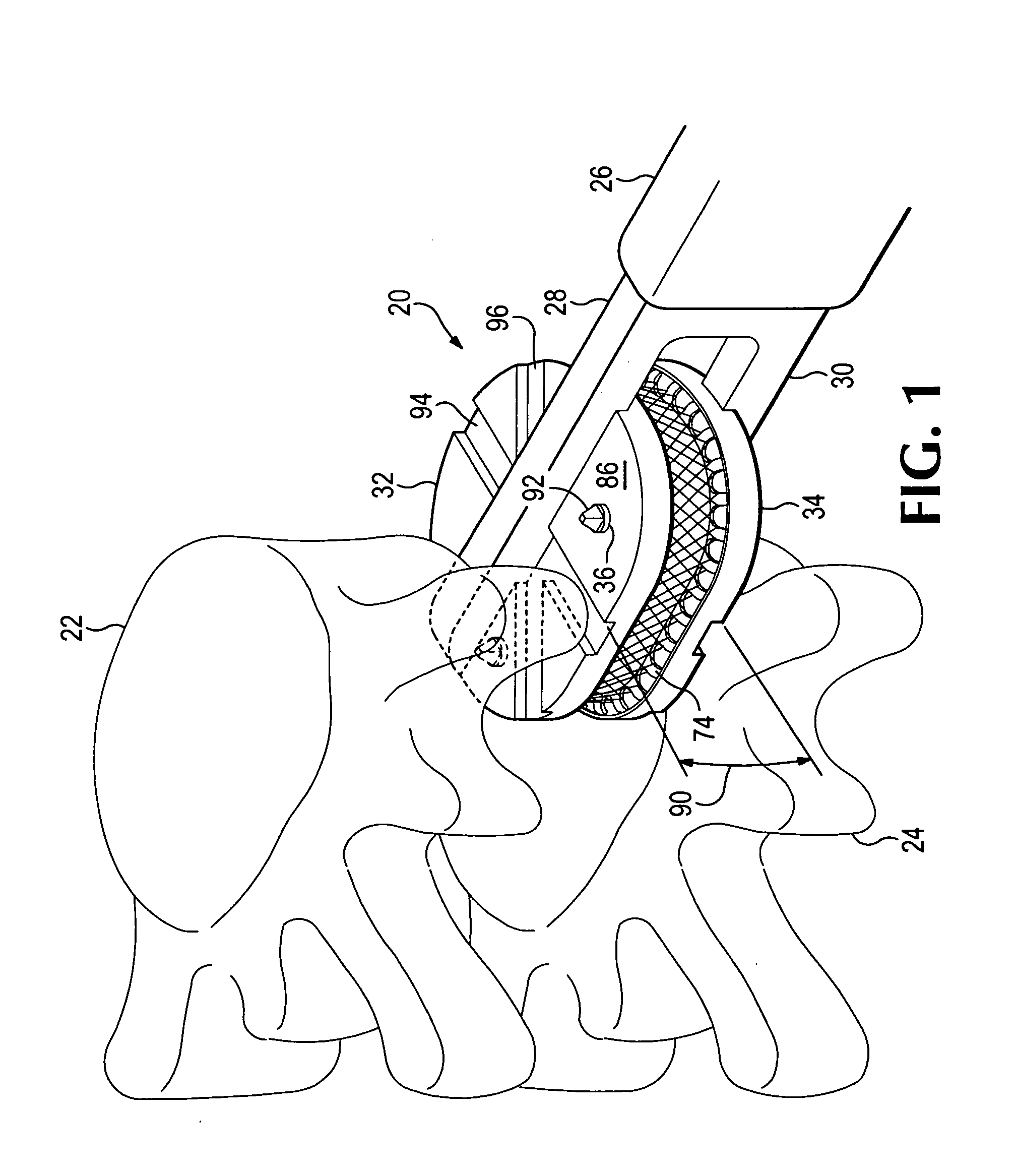 Anatomic total disc replacement