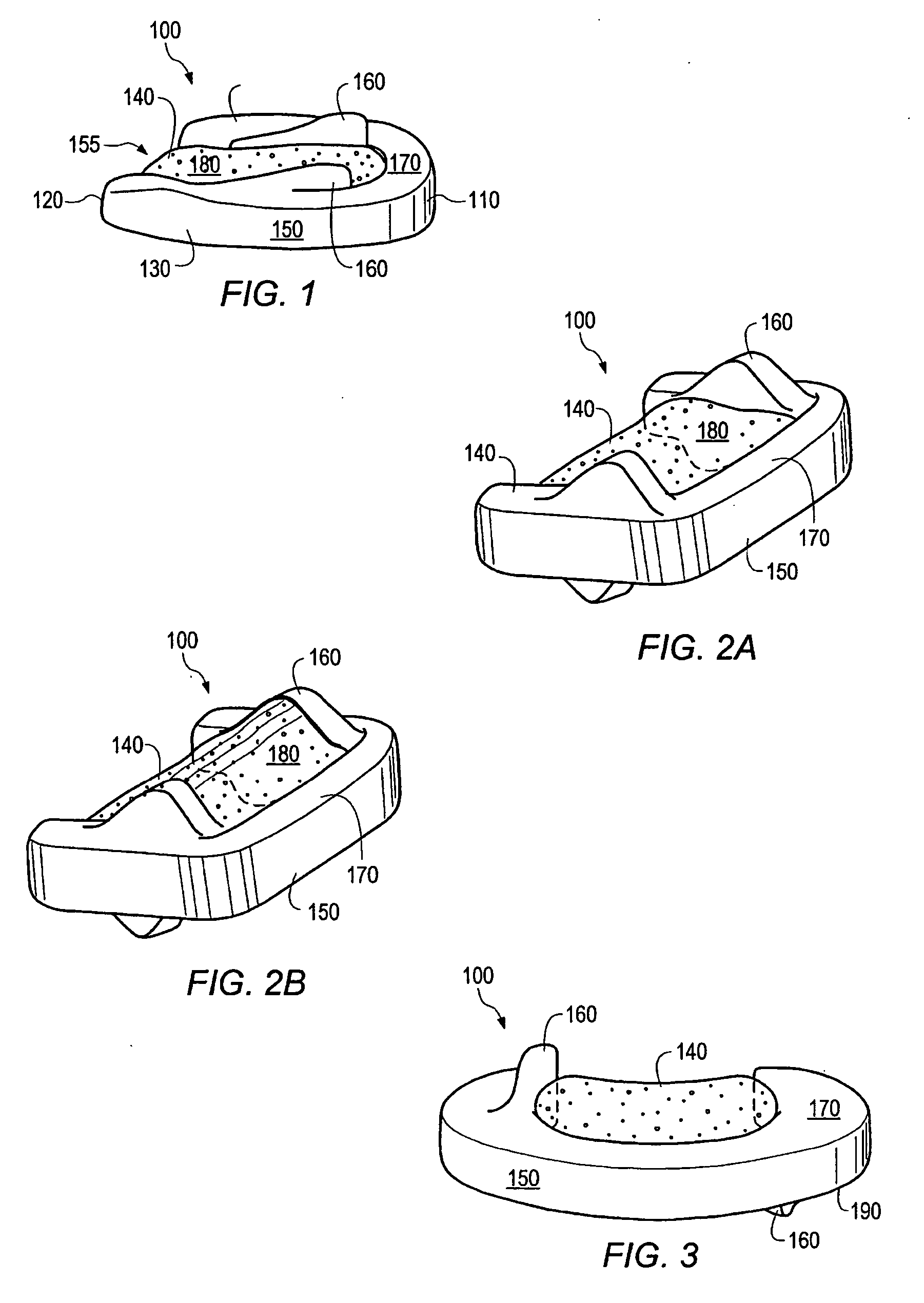 Hardened calcium phosphate cement bone implants