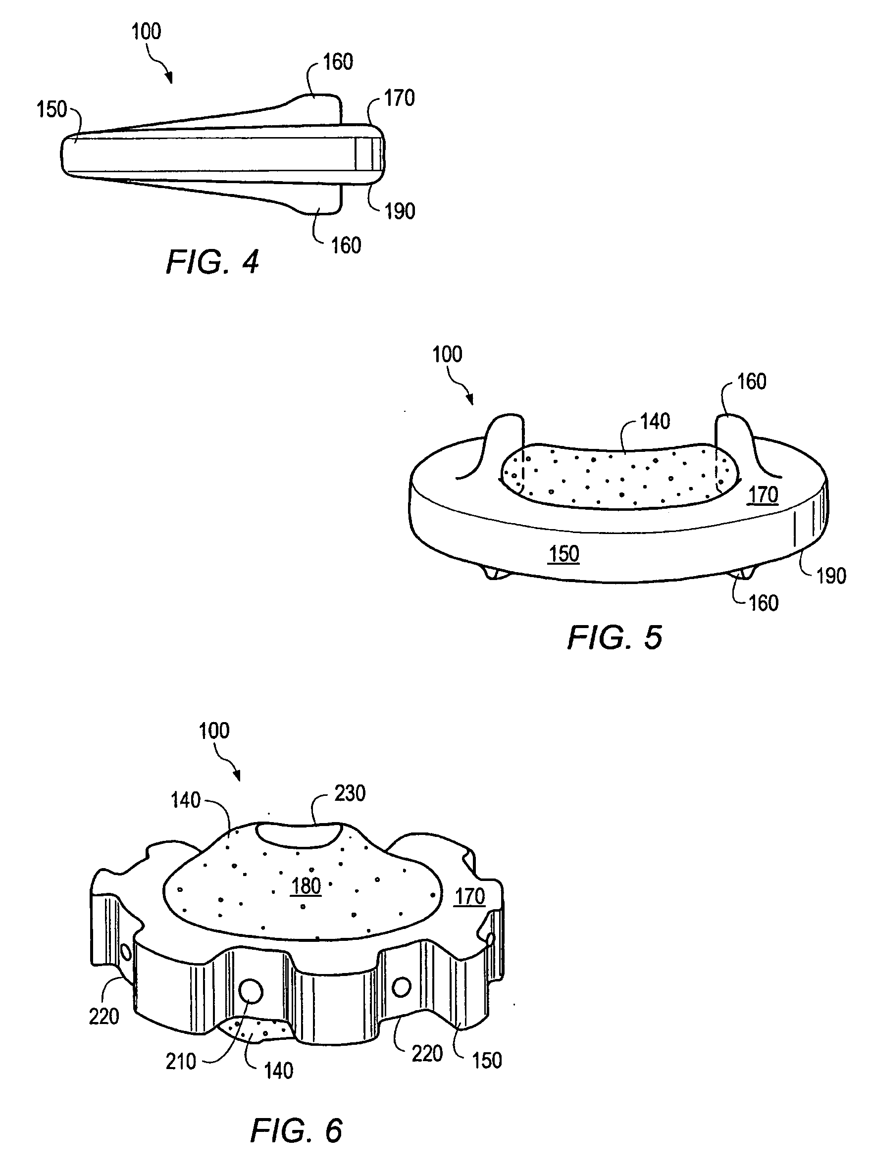 Hardened calcium phosphate cement bone implants