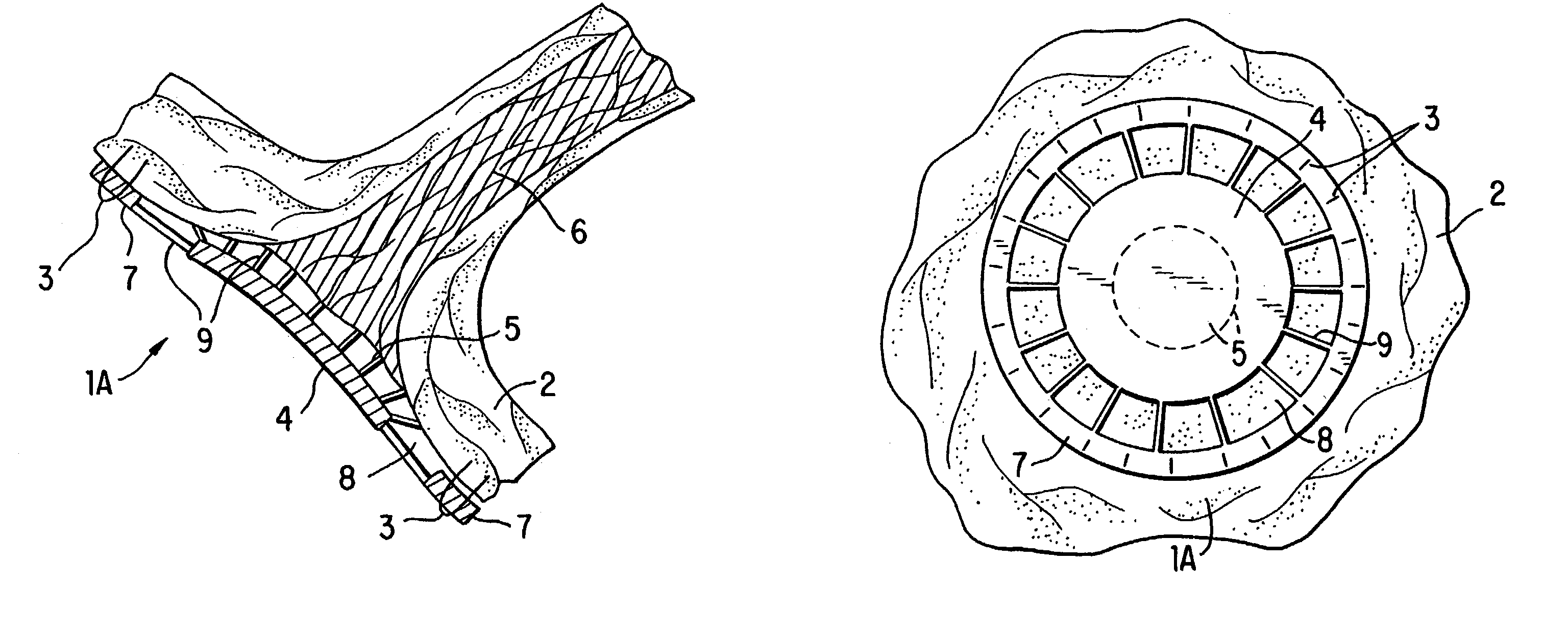 Method and devices for decreasing elevated pulmonary venous pressure