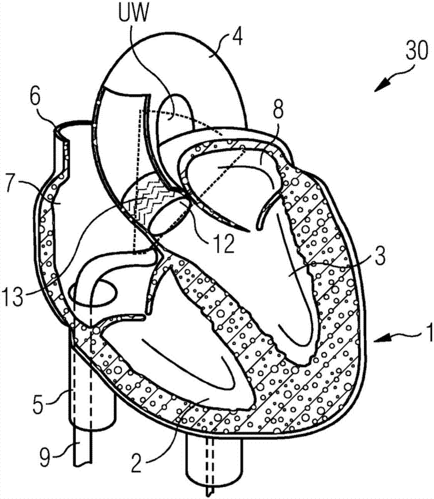 Arrangement For Monitoring A Positioning Of A Prosthetic Cardiac Valve And Corresponding Method